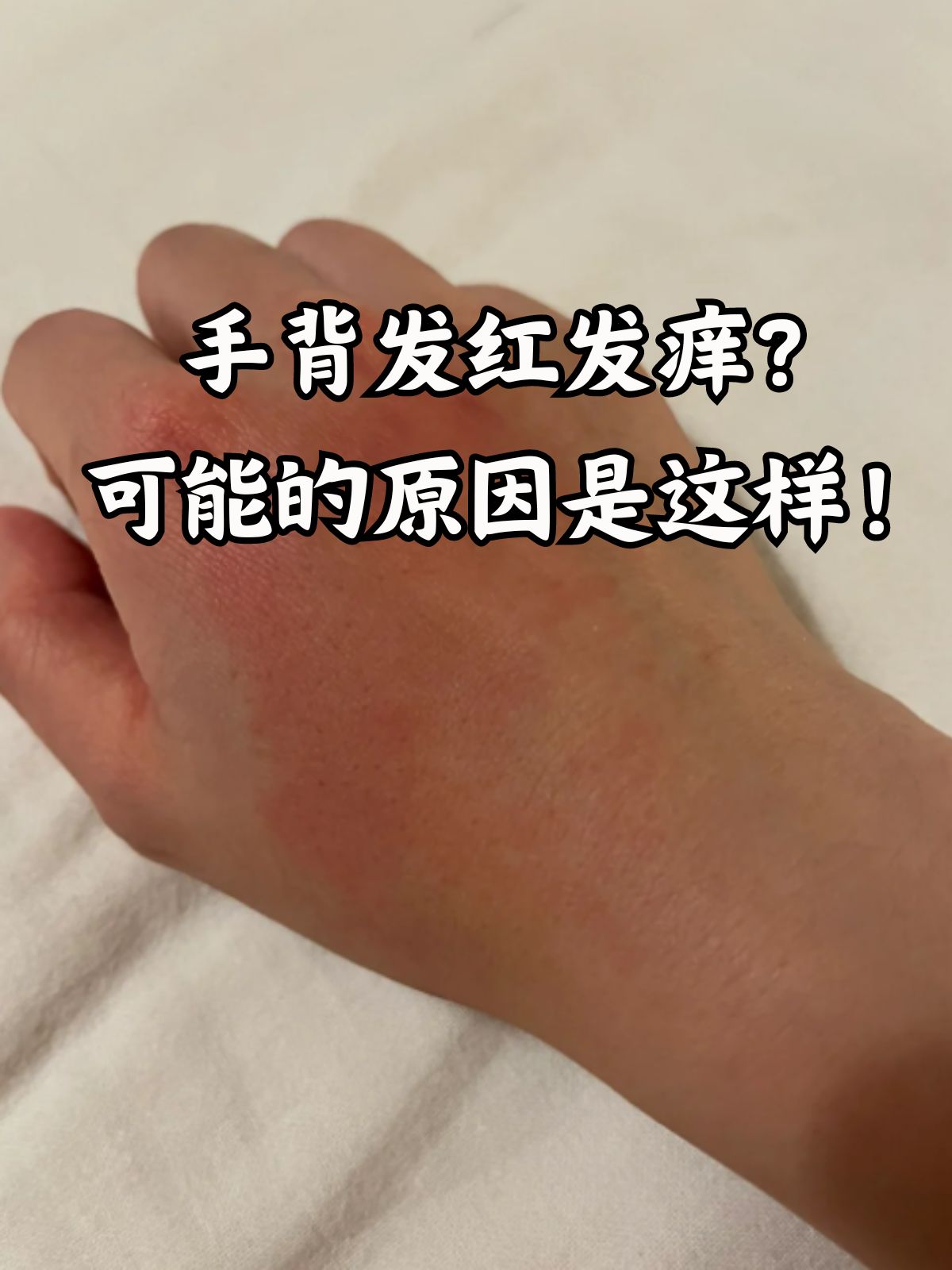 手背发红发痒这个问题可能困扰着很多人,尤其是那些皮肤敏感或经常