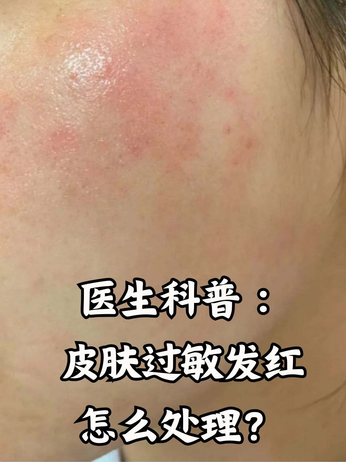 医生科普:皮肤过敏发红怎么处理?