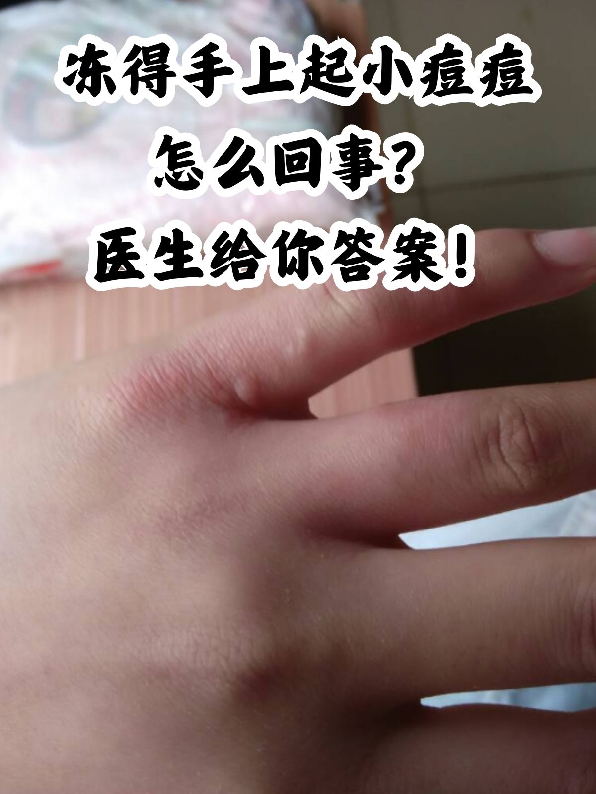 冻了起疙瘩图片手背冻了会起痘痘吗手上长疙瘩要警惕手上长小痘痘有啥
