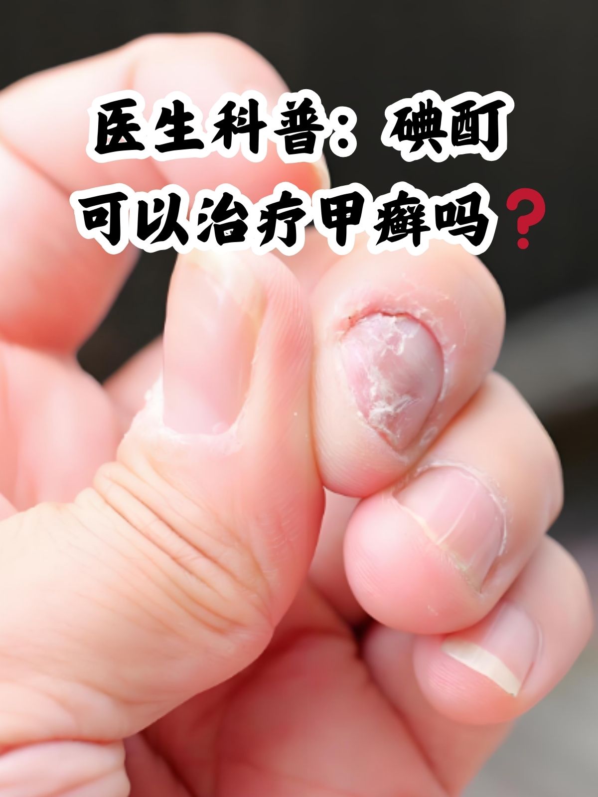 医生科普:碘酊可以治疗甲癣吗 甲癣是一种由皮肤癣菌侵犯甲板及甲下所