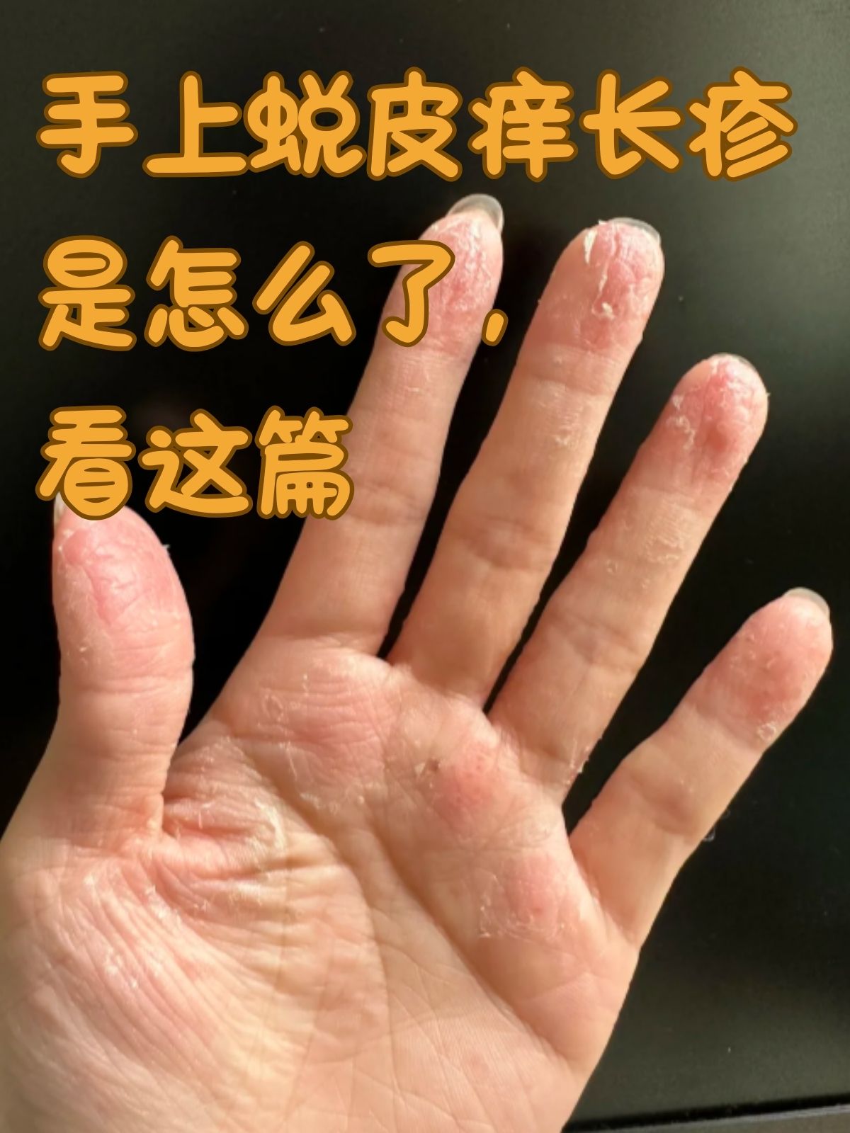 手脱皮是怎么回事图片