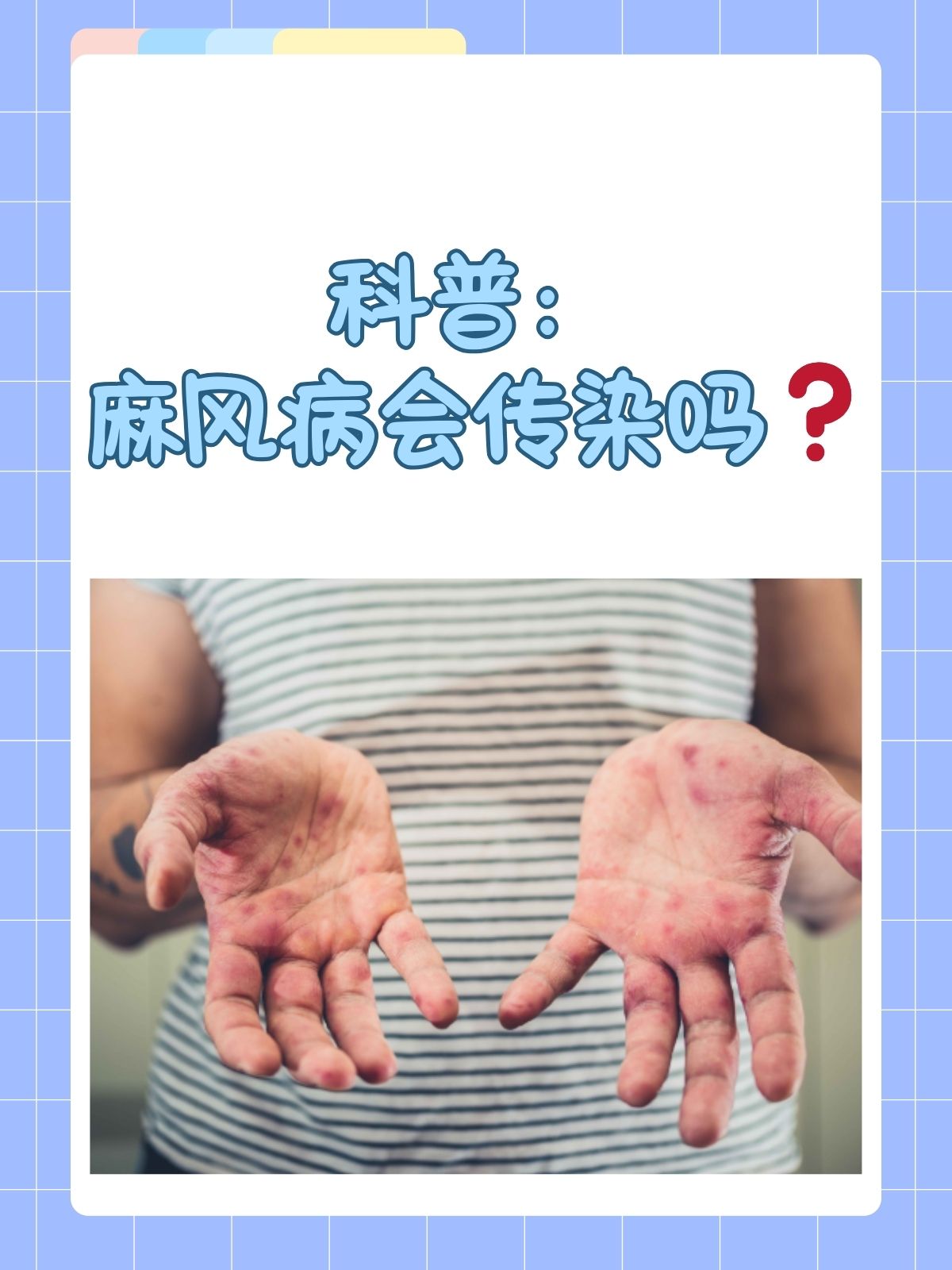 科普:麻风病会传染吗 麻风病大家应该都听过吧,这是一种由麻风分枝