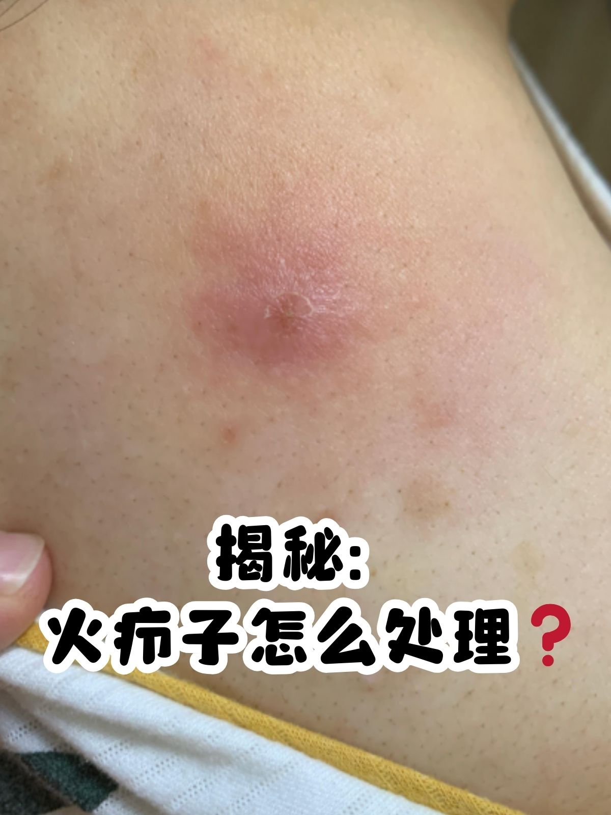 药物治疗 如果火疖子出现发红,疼痛等症状,可以在医生指导