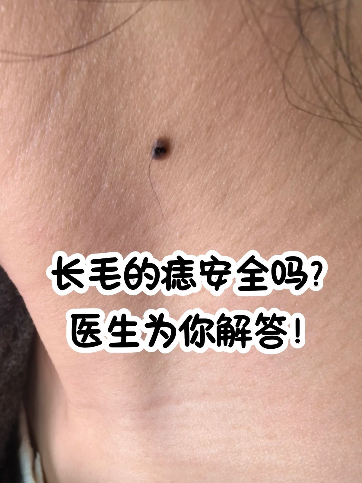 上长毛天生黑毛痣不要去动人体痣部位解析图毛痣图片长毛的痣痣长了