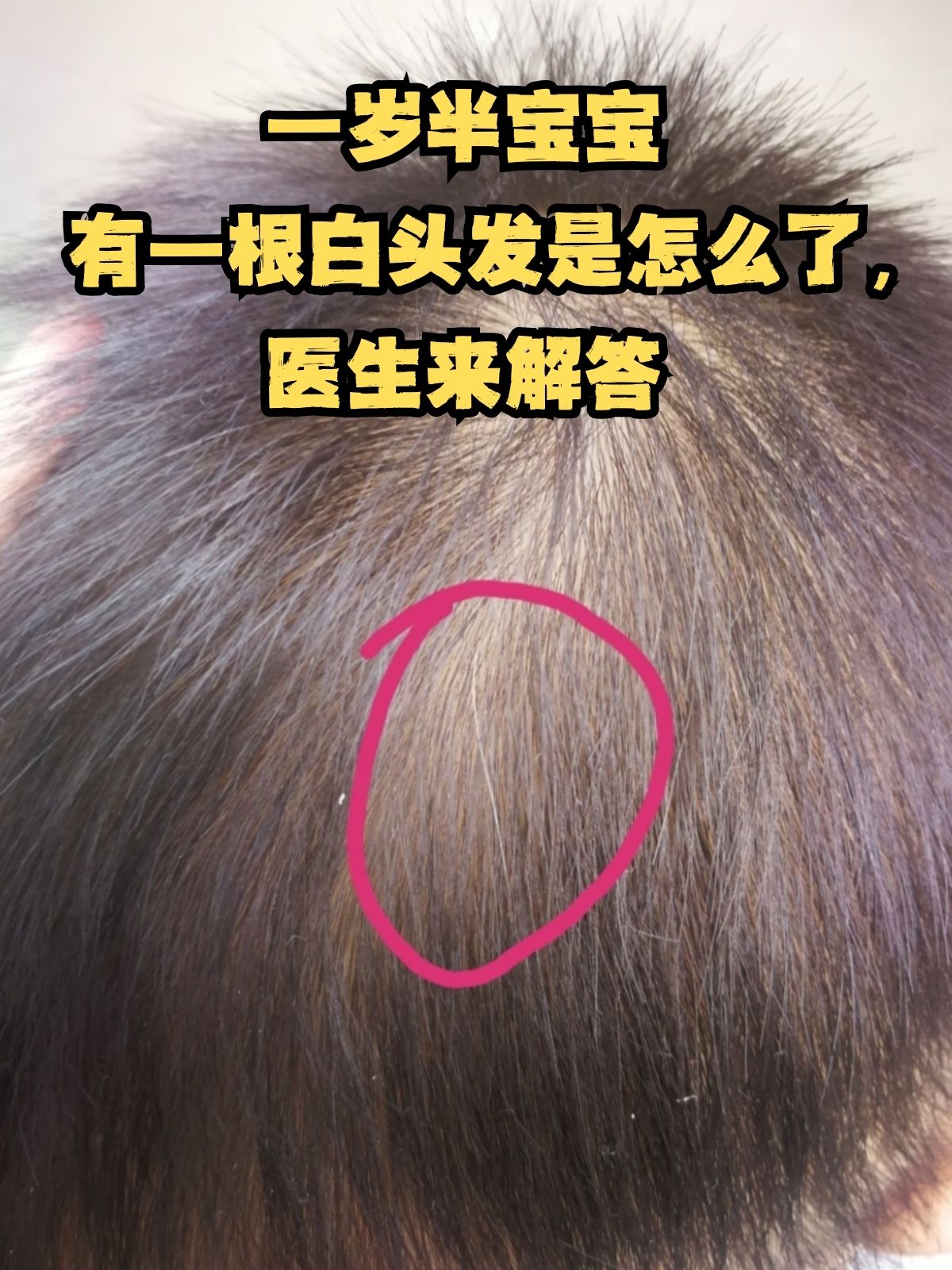 一岁半宝宝长白发可能是以下几点原因造成的 遗传