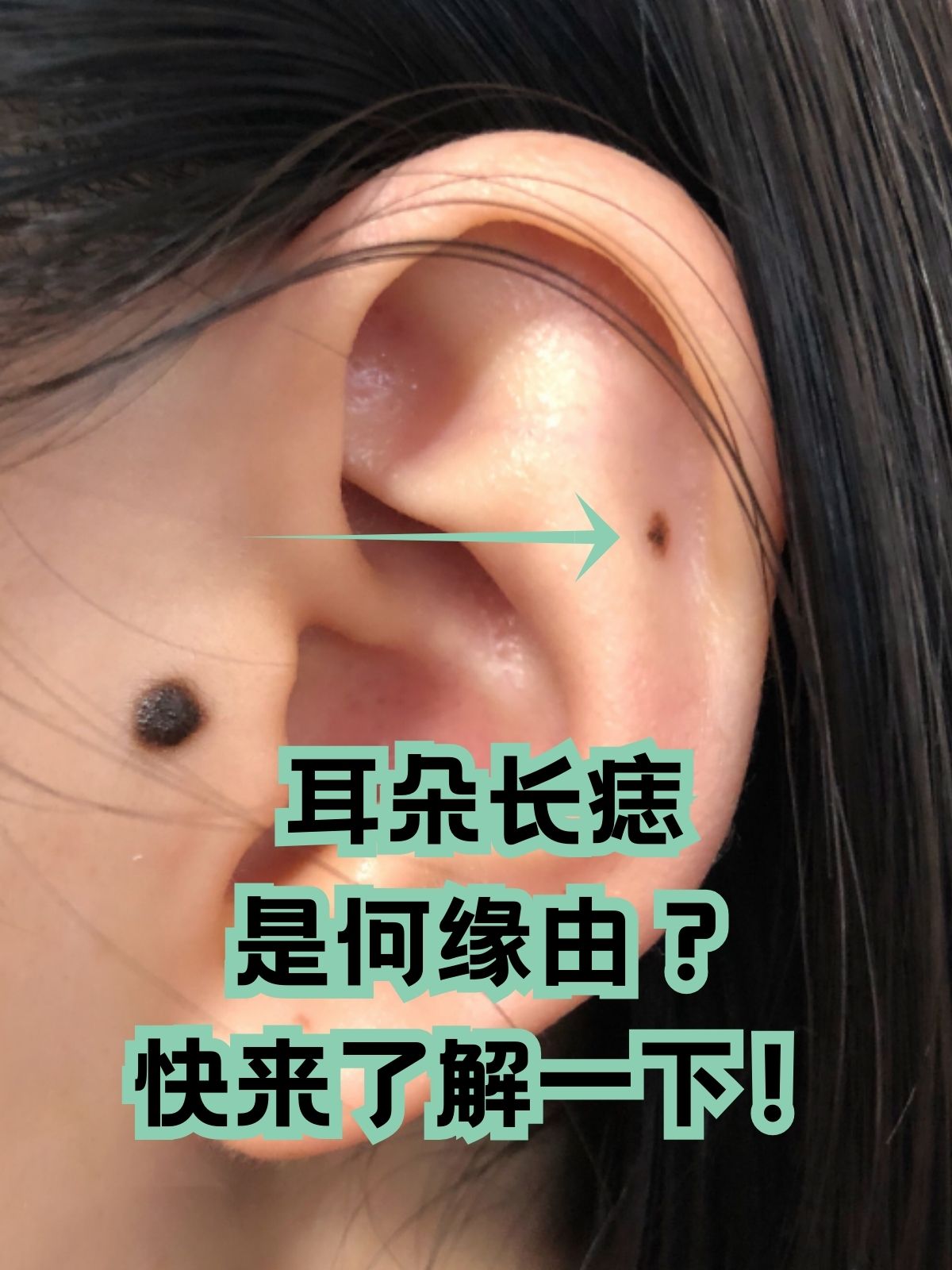 "耳朵长痣"这一现象其实在日常很常见,背后的原因也有很多