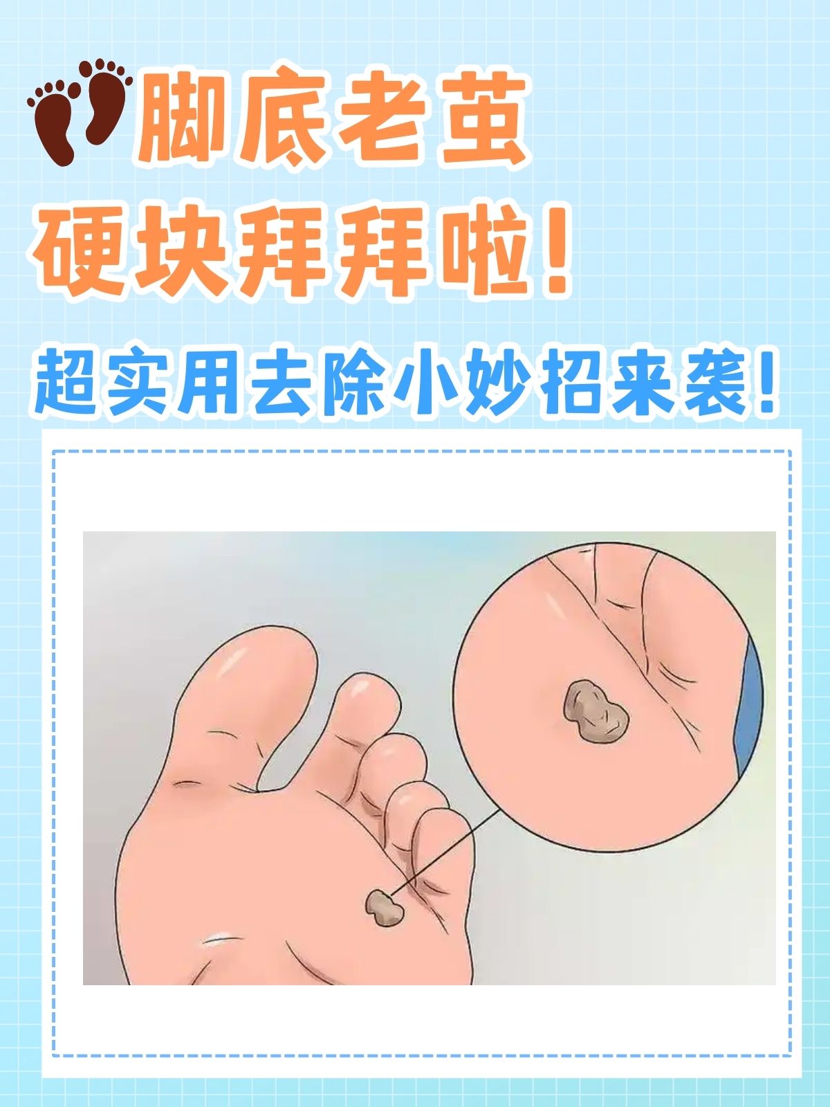 不仅影响美观,还可能胼胝怎么治疗脚上长鸡眼怎么去除最好方法胼胝