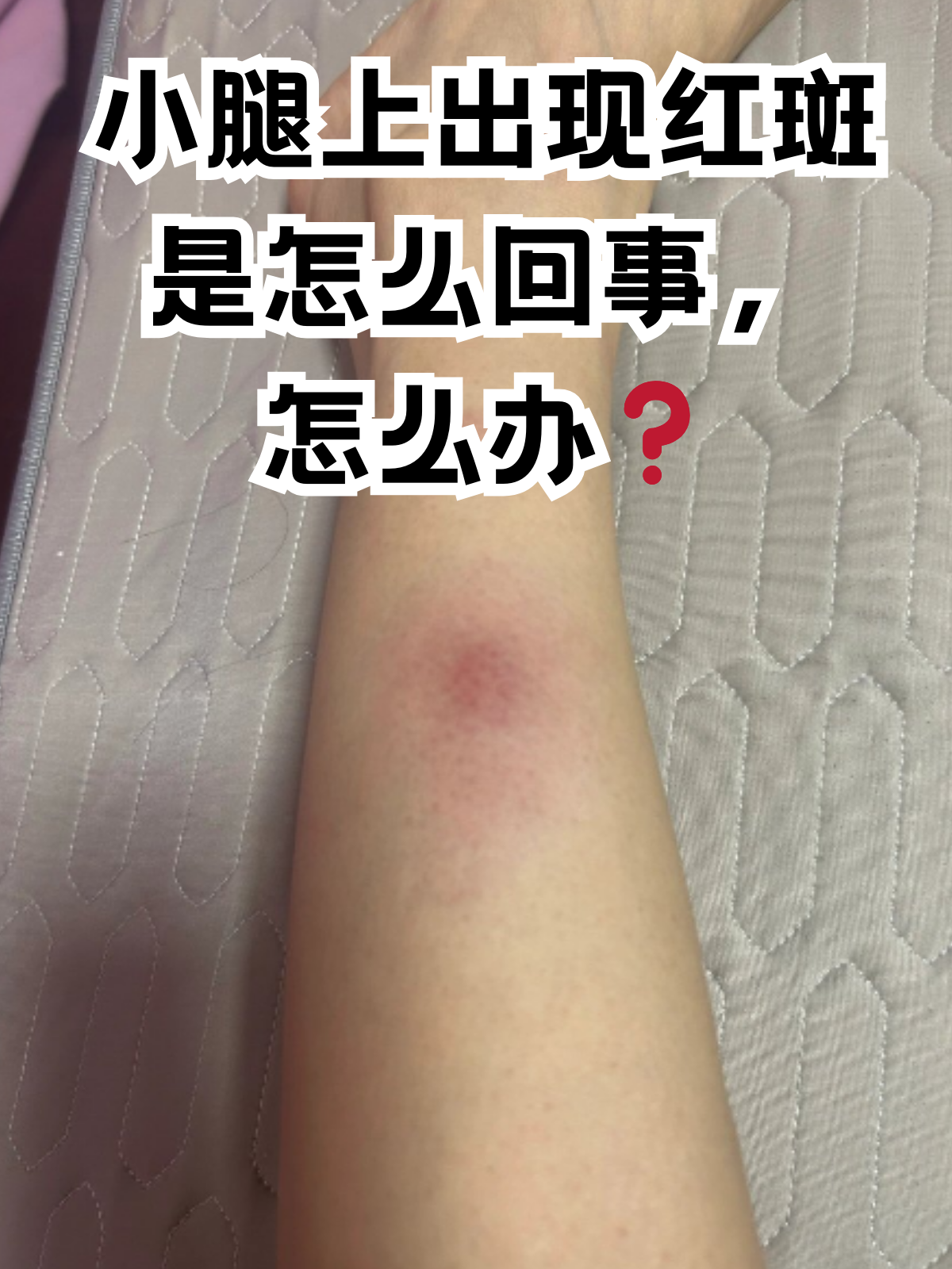 小腿上出现红斑是怎么回事,怎么办 你有没有过这样的经历,那就是突然