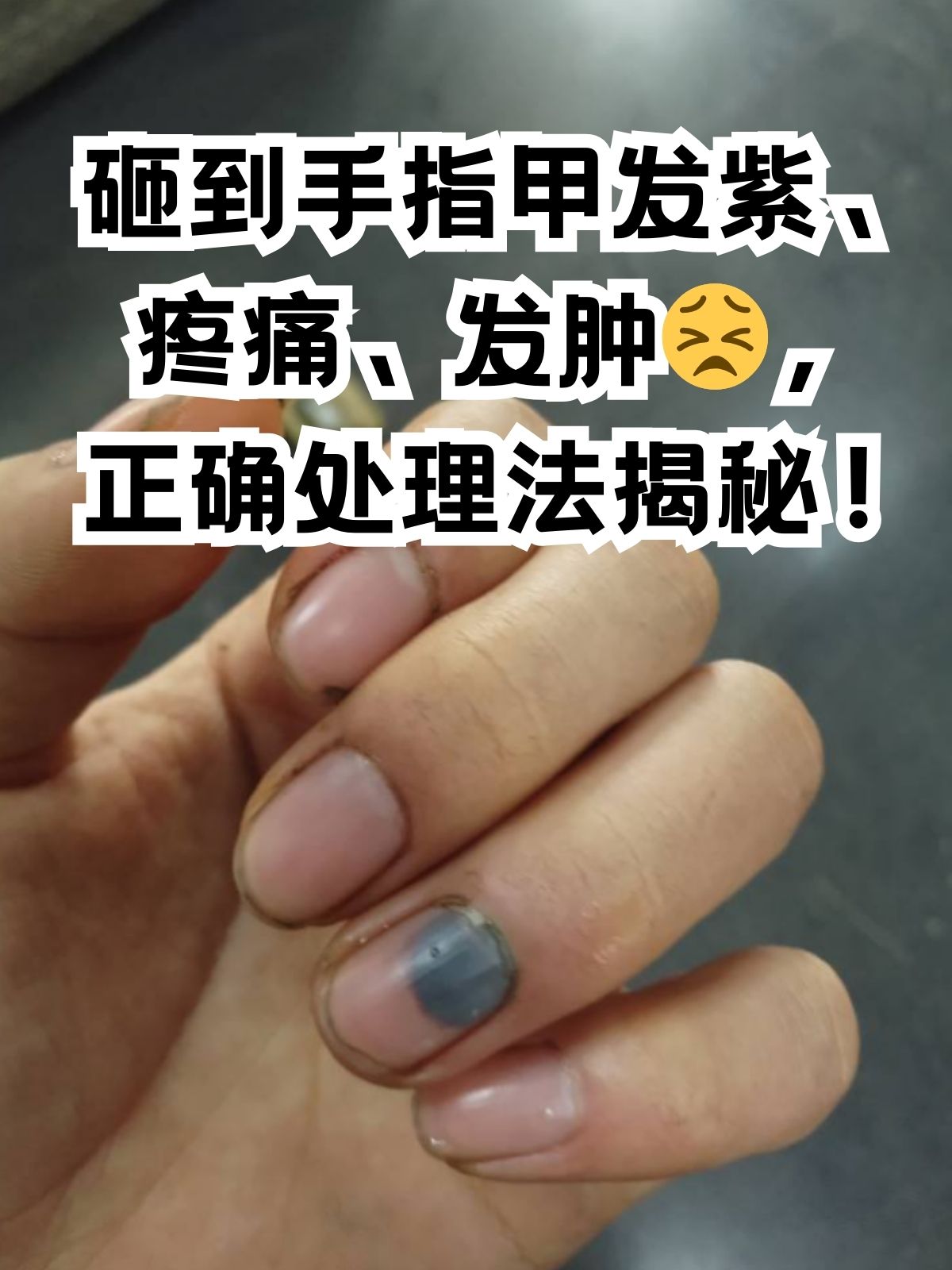生活中难免有些小意外,如果不小心砸到手指,瞬间指甲发紫,疼痛难忍