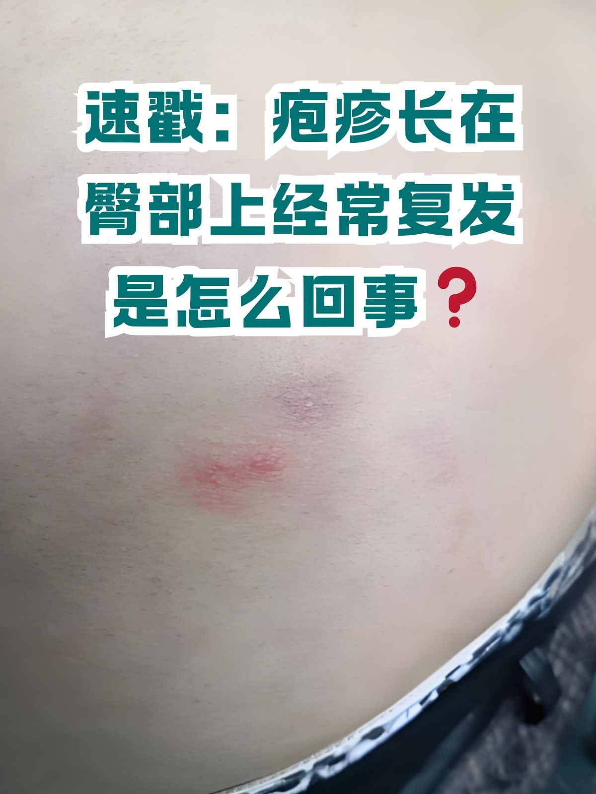 疱疹是什么症状图片疱疹图片和症状图片屁股上长疱疹图片女性屁股长
