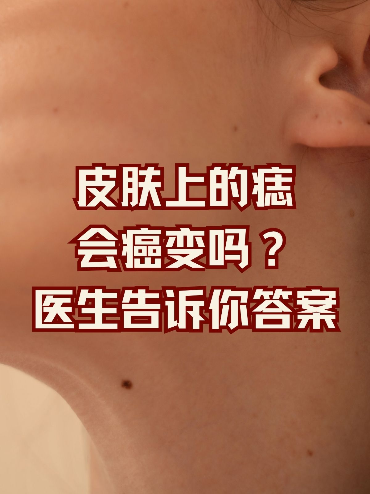 为什么会长痣