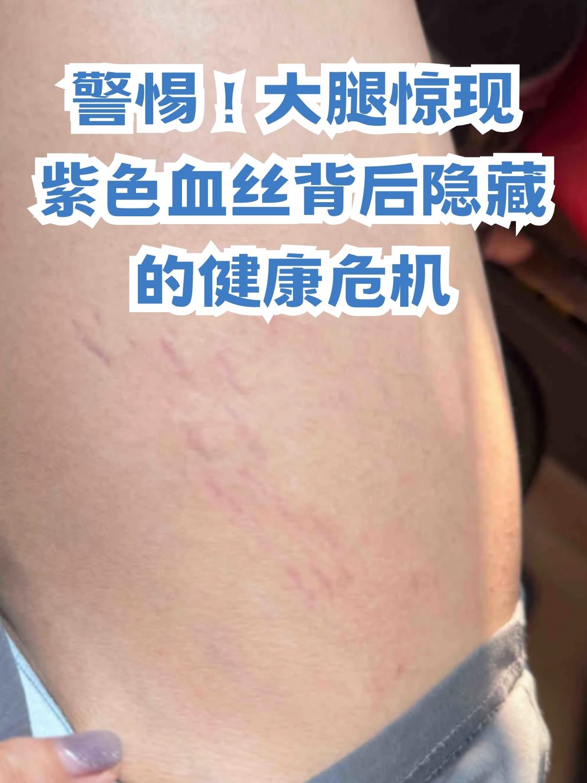 大腿惊现紫色血丝背后隐藏的健康危机 气温逐渐转凉
