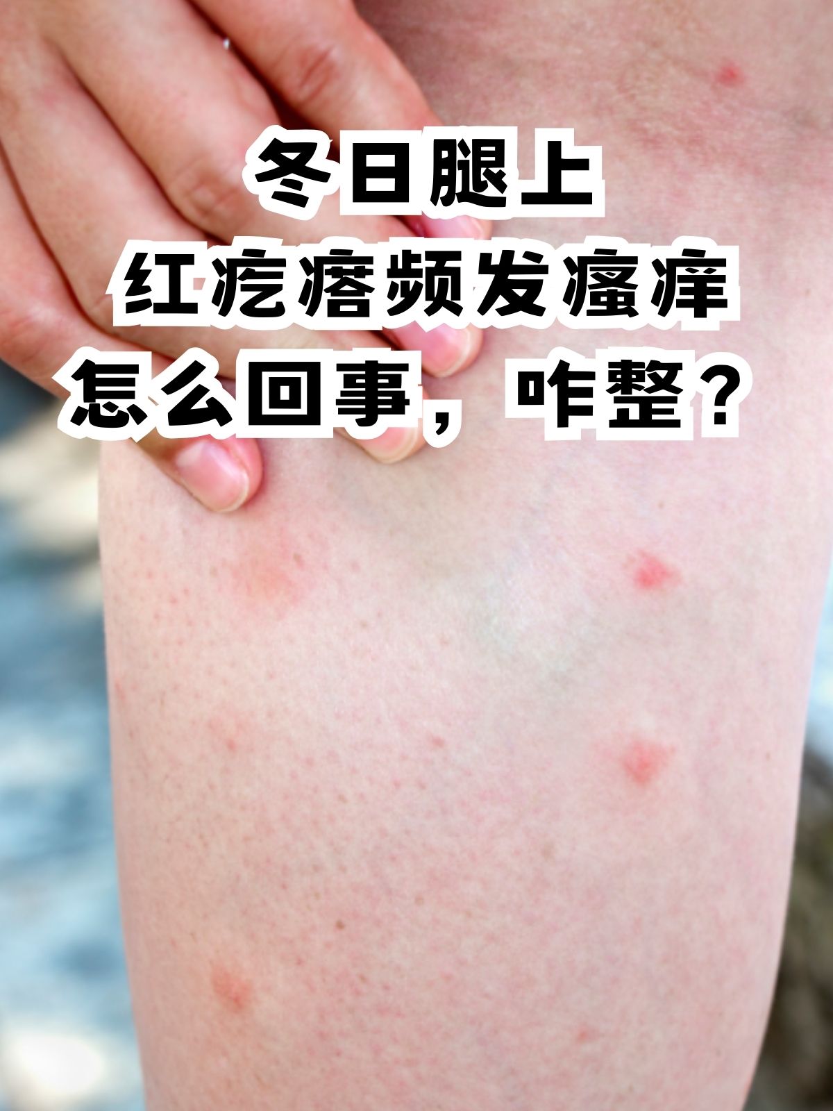 原因一:皮肤干燥 冬天空气