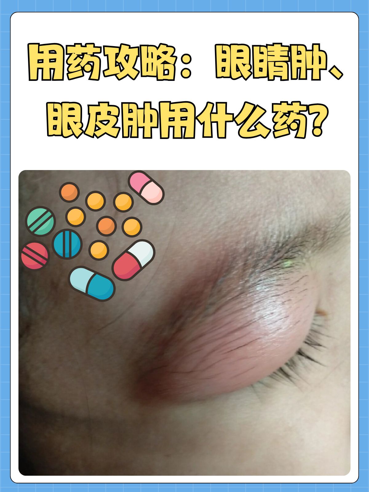 眼睛为什么会肿