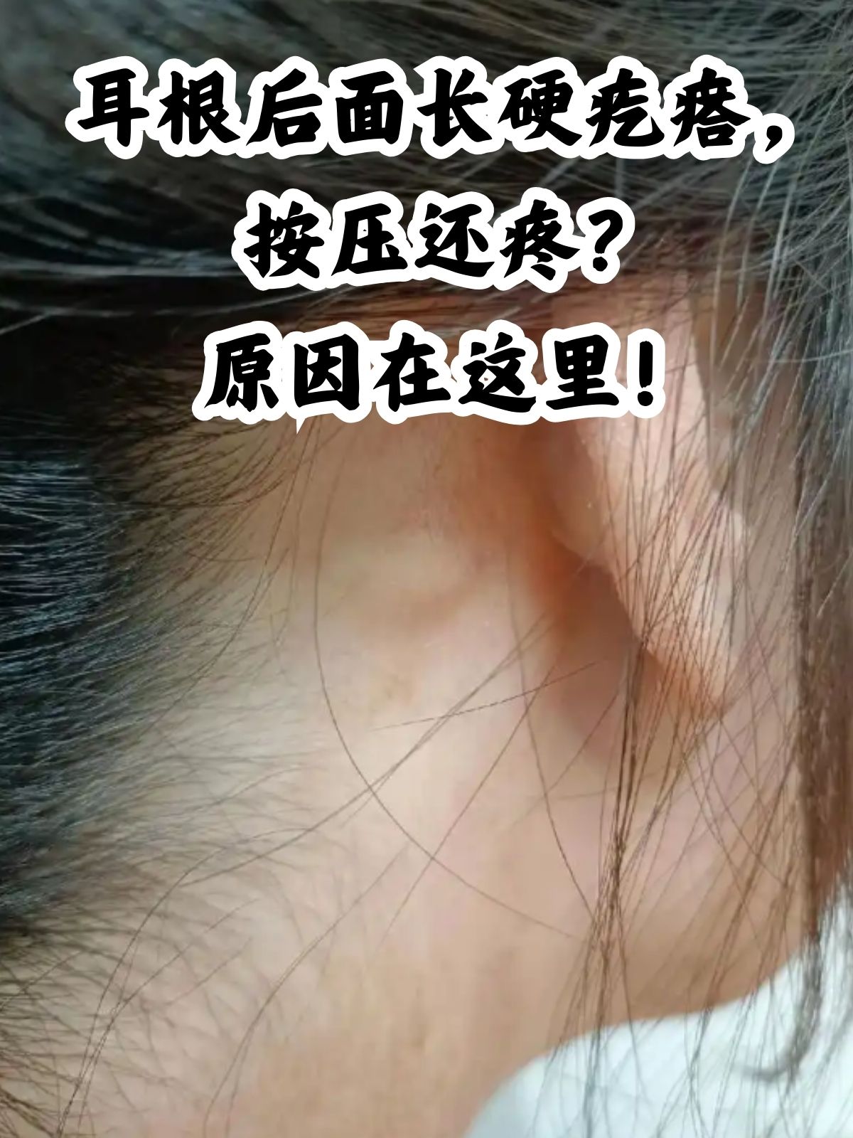 耳后淋巴结肿大 耳后淋巴结肿大可能是由炎症或感染引起的