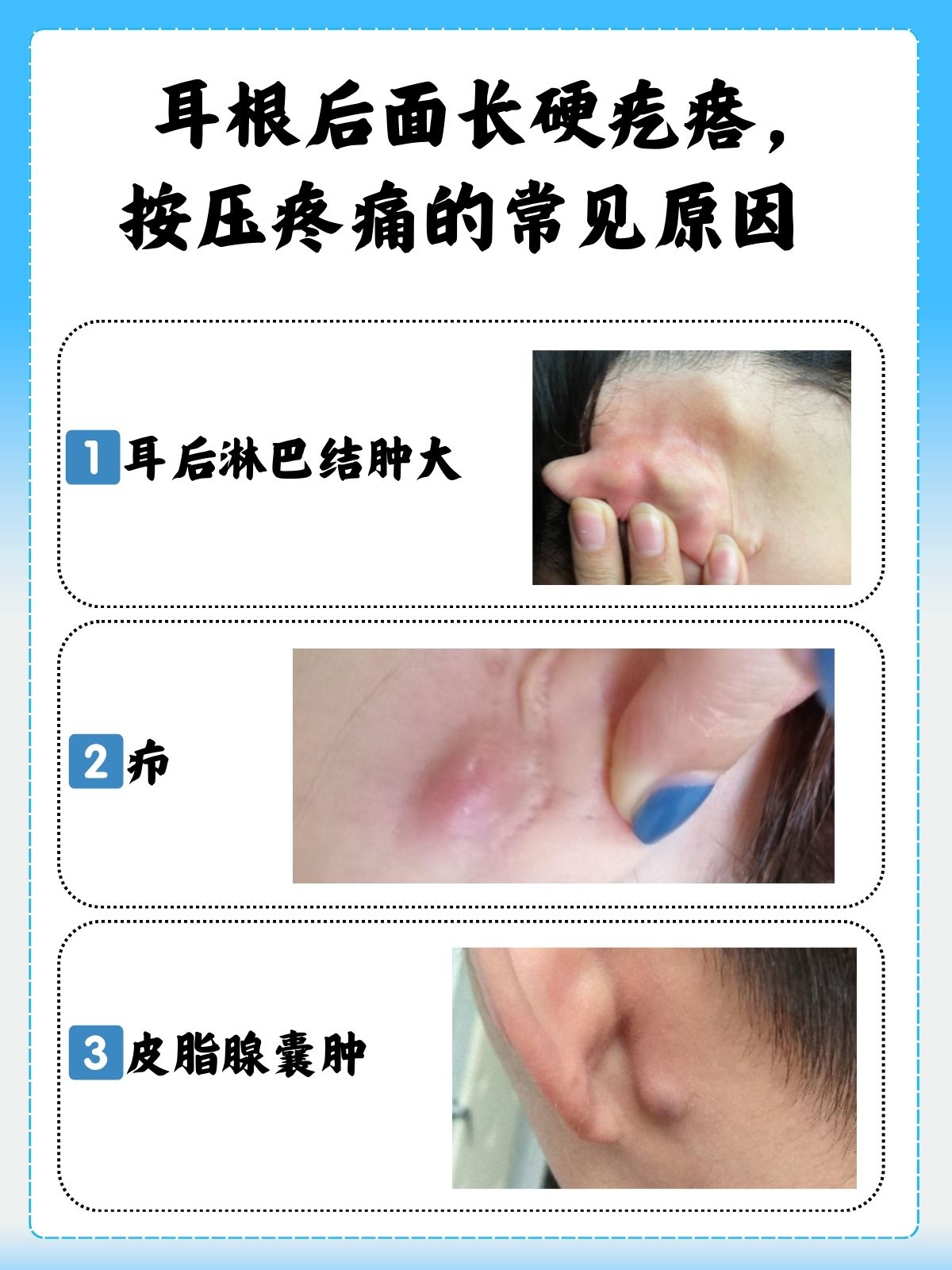 按压疼痛,较为常见的原因有耳后淋巴结肿大,疖,皮脂腺囊肿等