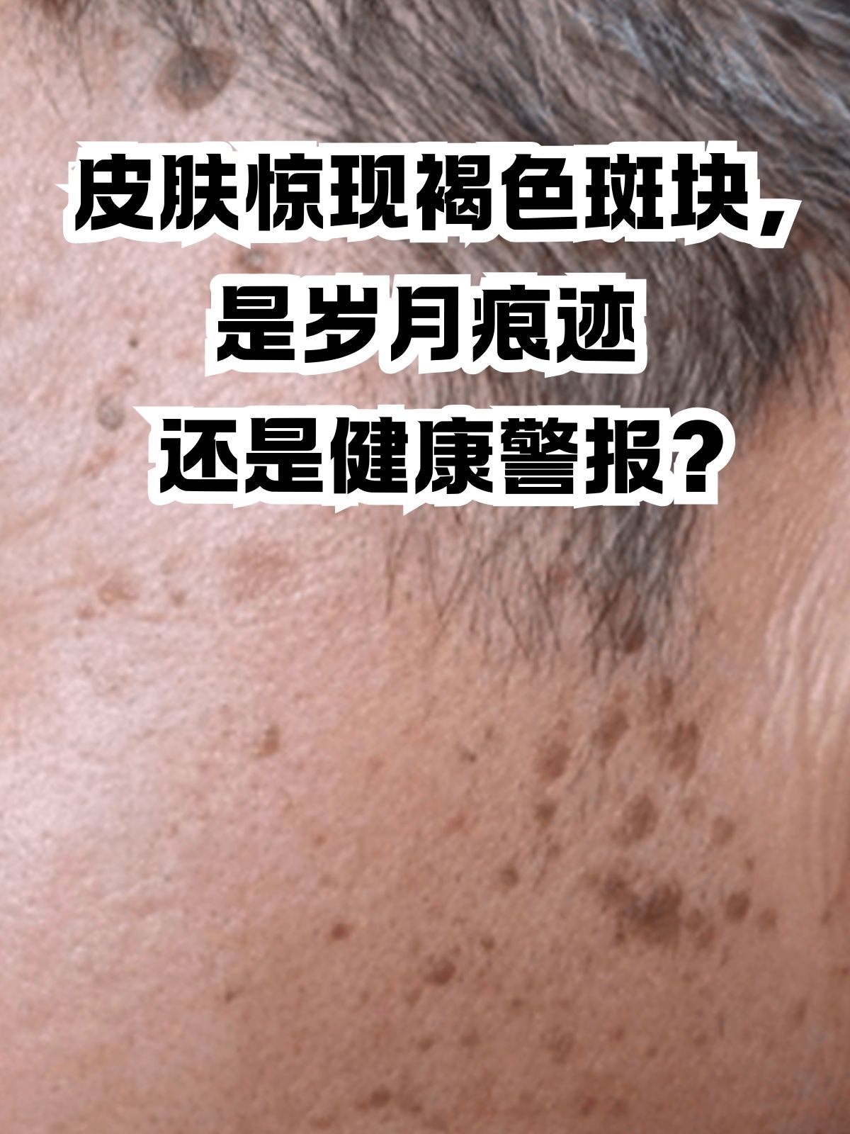 皮肤老化 随着年龄的增长皮肤会逐渐老化出现色斑皱纹