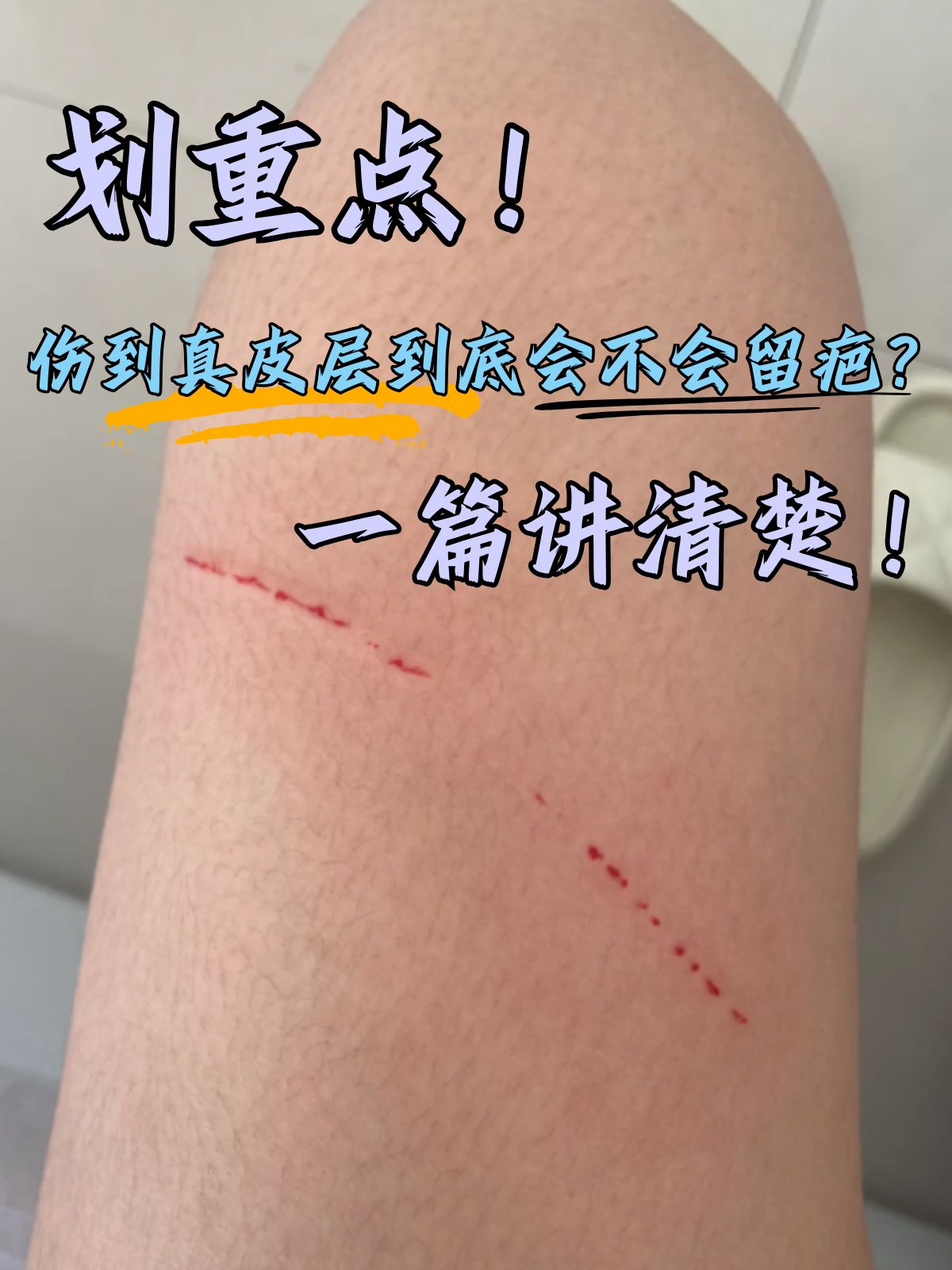 划重点!伤到真皮层到底会不会留疤?一篇讲清楚!