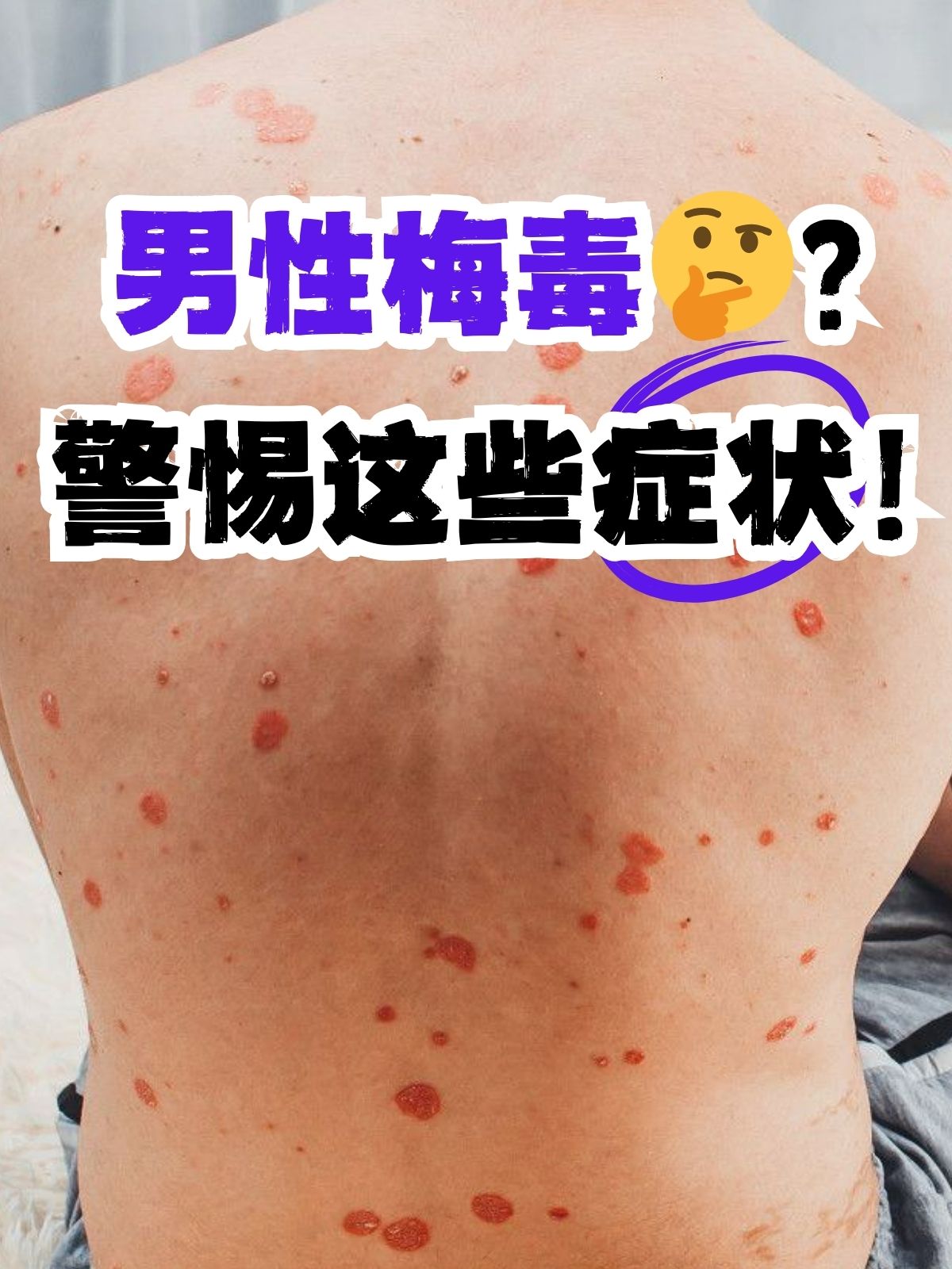 今天,我们就来揭秘男性梅毒的症状,只有了解它的症状,才能帮大家在