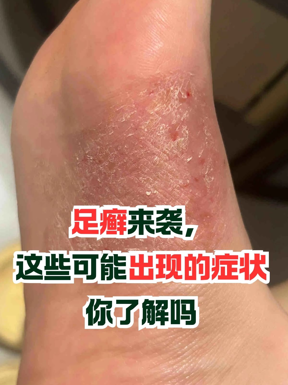 足癣来袭,这些可能出现的症状你了解吗 足癣是一种常见的足部问题
