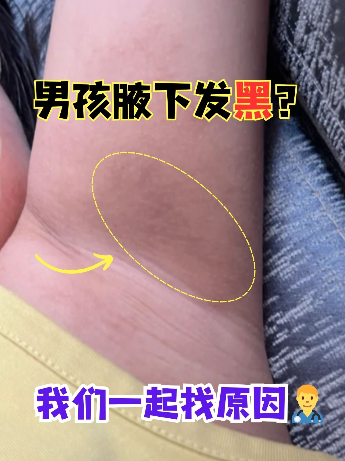 抵抗腋下发黑图片腋窝黑棘皮图片腋窝黑棘皮腋下黑棘皮图片腋下黑