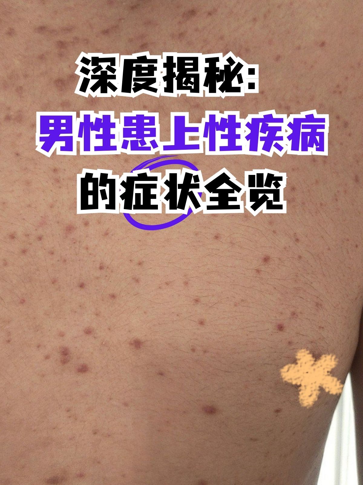 深度揭秘:男性患上性疾病的症状全览 性疾病,作为一类通过性接触传播