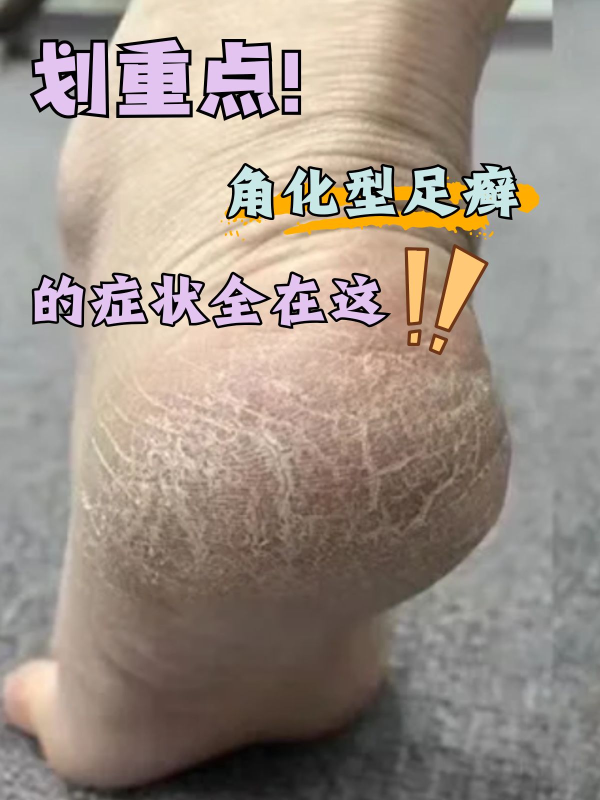 常见症状包括: 皮肤干燥:由于真菌感染,足癣足藓脚上皮肤病识别图脚气