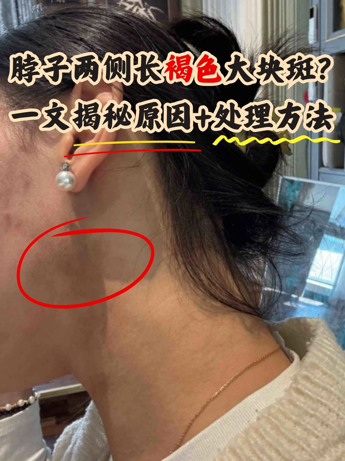 一文揭秘原因 处理方法 如果脖子两侧出现大块的褐色斑,可能会让人