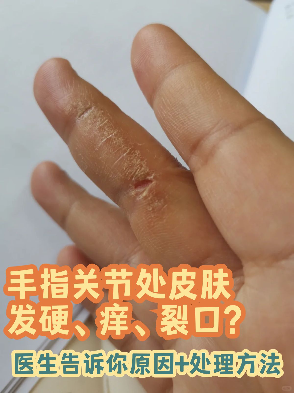 要是手指关节处的皮肤发硬,发痒,还出现了裂口,不光让人难受,还可能