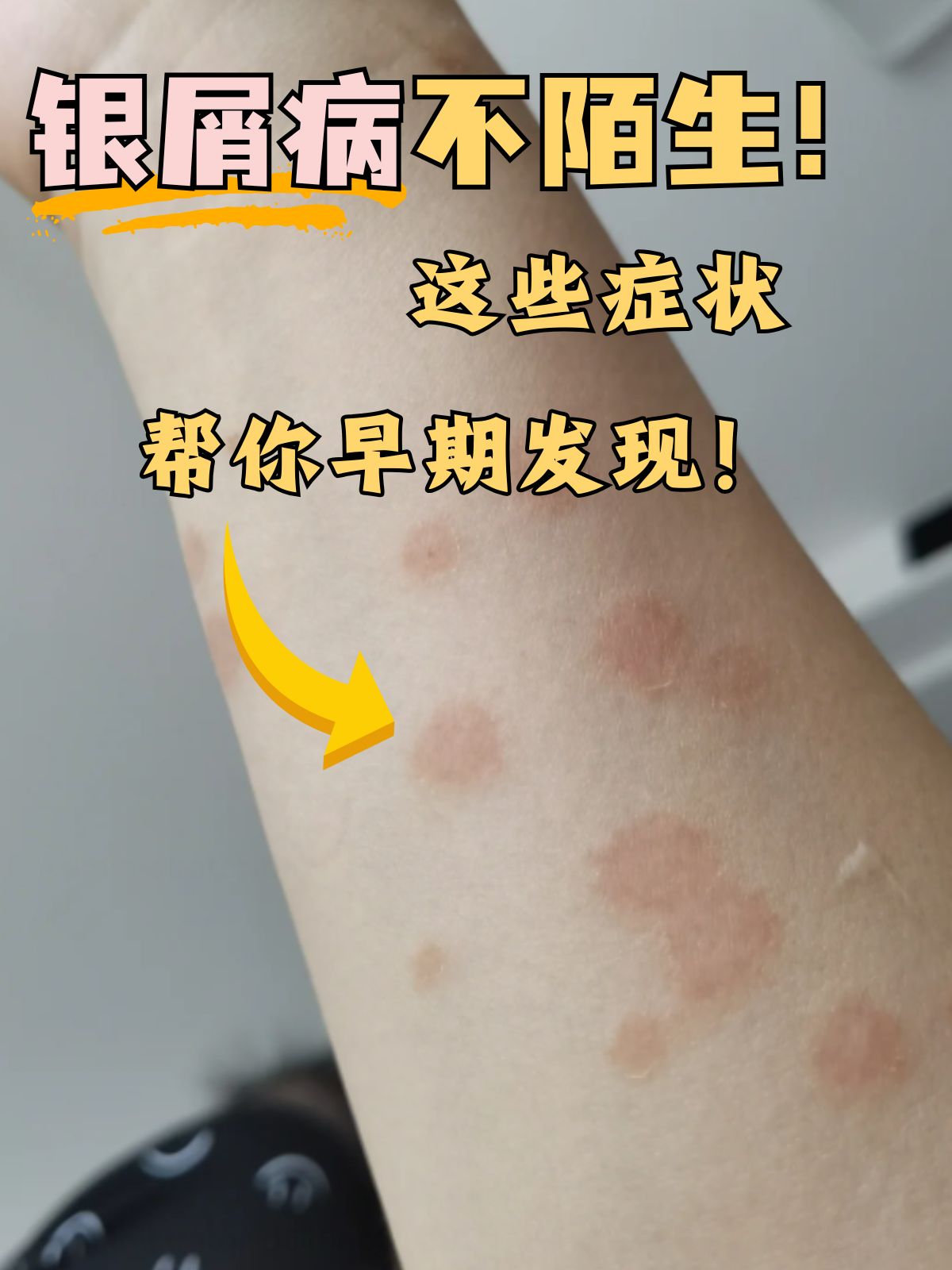 银屑病不陌生!这些症状帮你早期发现!