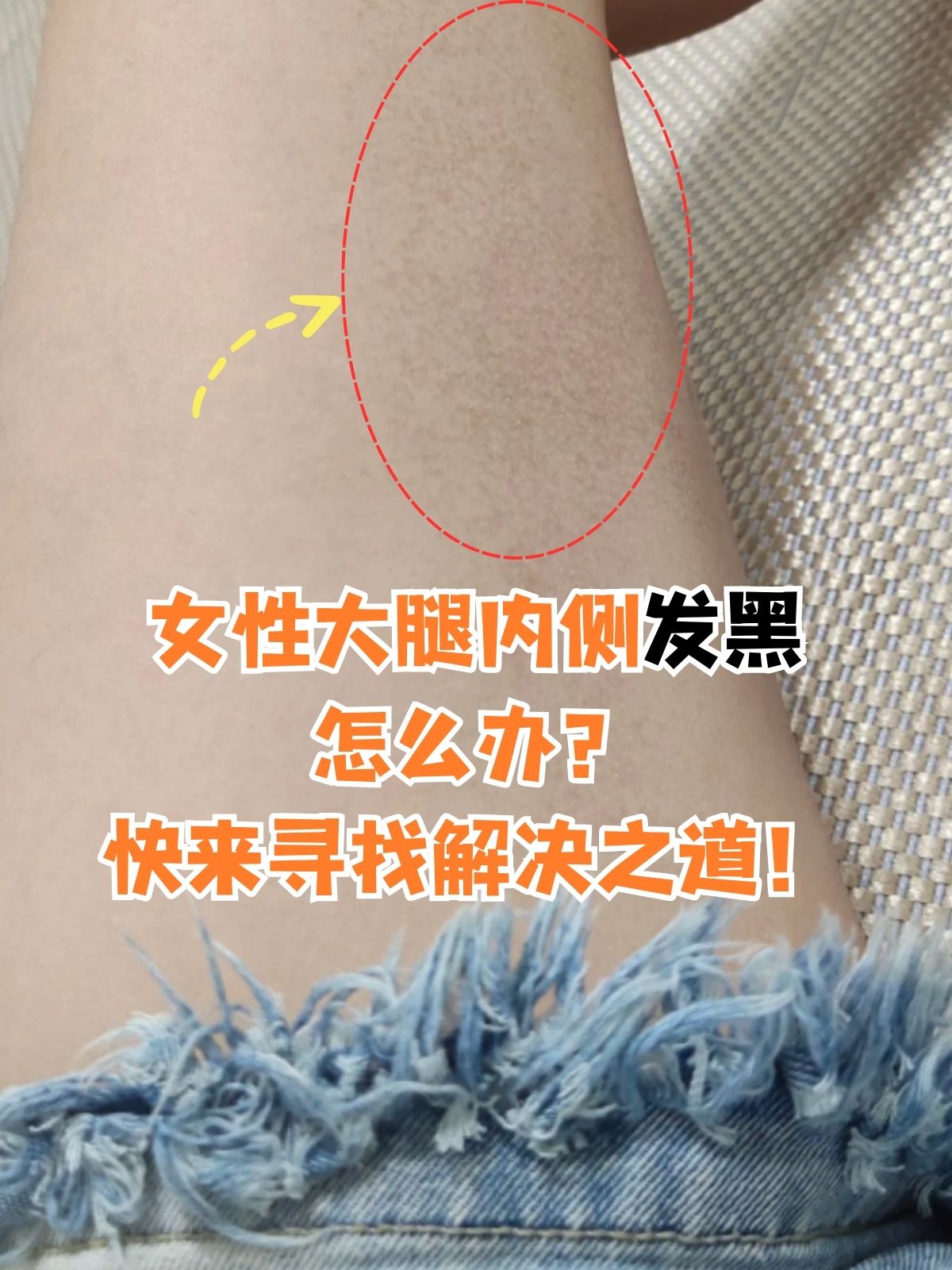 女性大腿内侧发黑,这一看似不起眼却让人困扰的问题,往往与生活习惯
