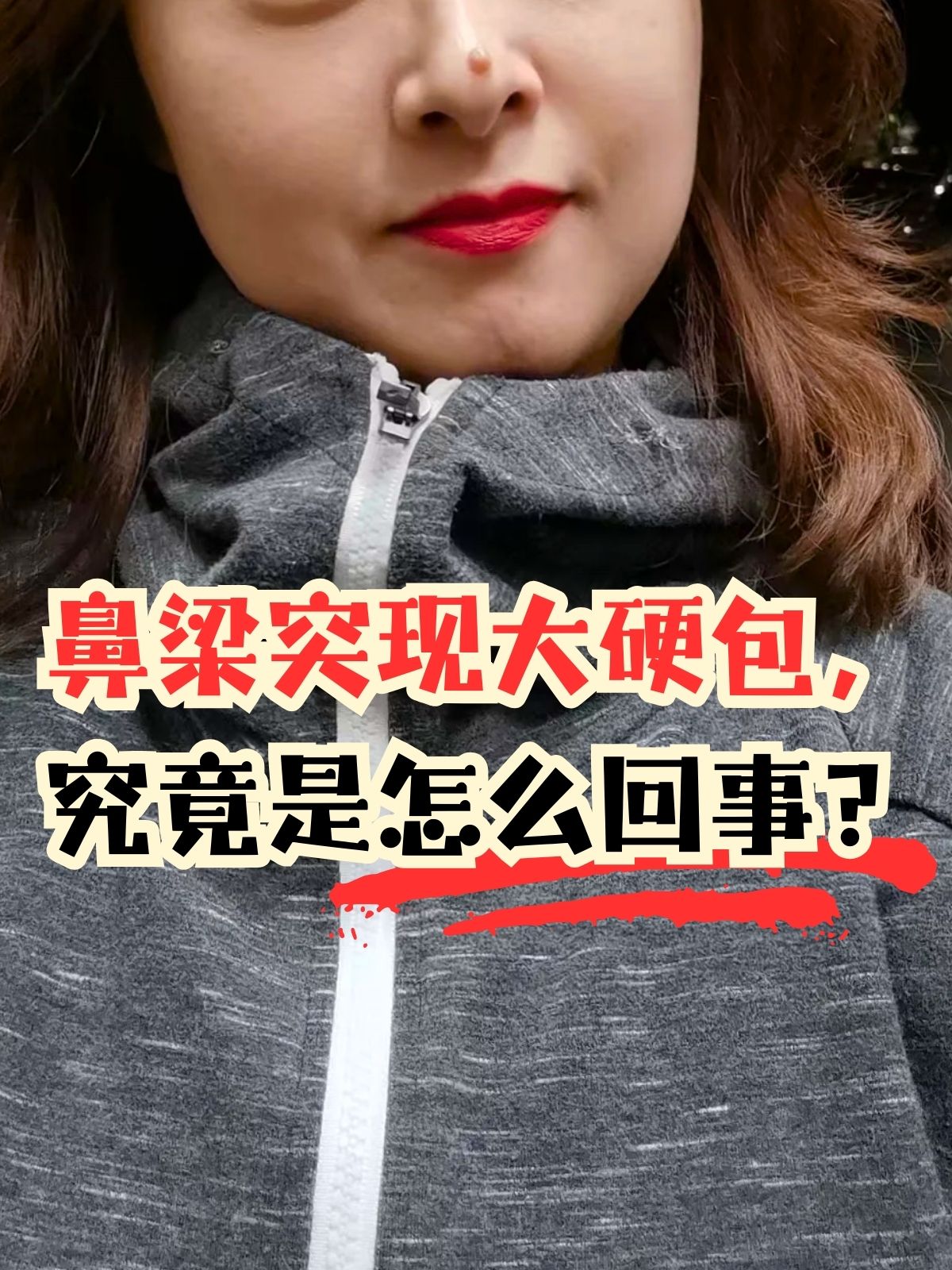 鼻梁中间骨头凸起图片鼻子上增生性凸起怎么去除鼻子侧面有硬包图片