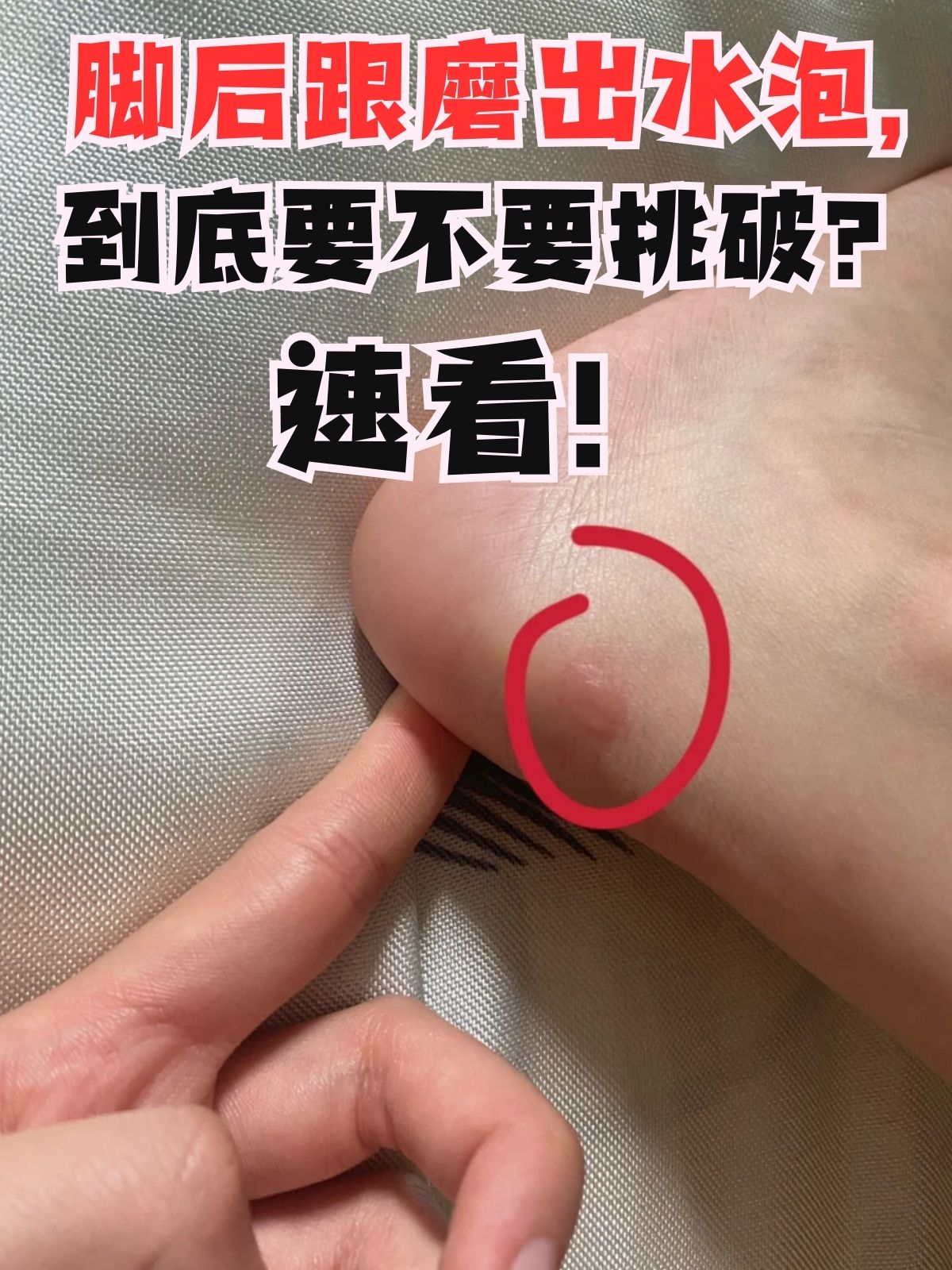 脚后跟磨出水泡是许多人在日常生活中都可能遇到的问题,尤其是在穿着