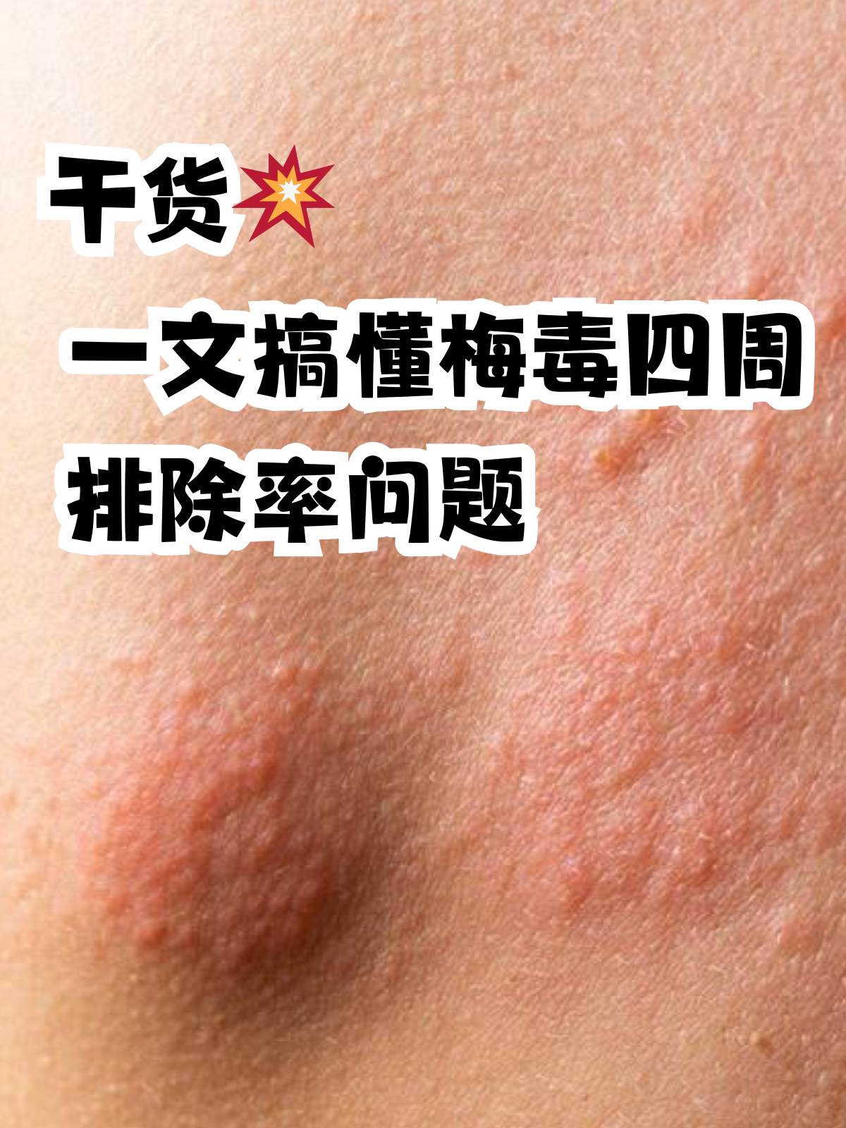 梅毒15年了自己不知道为什么在线