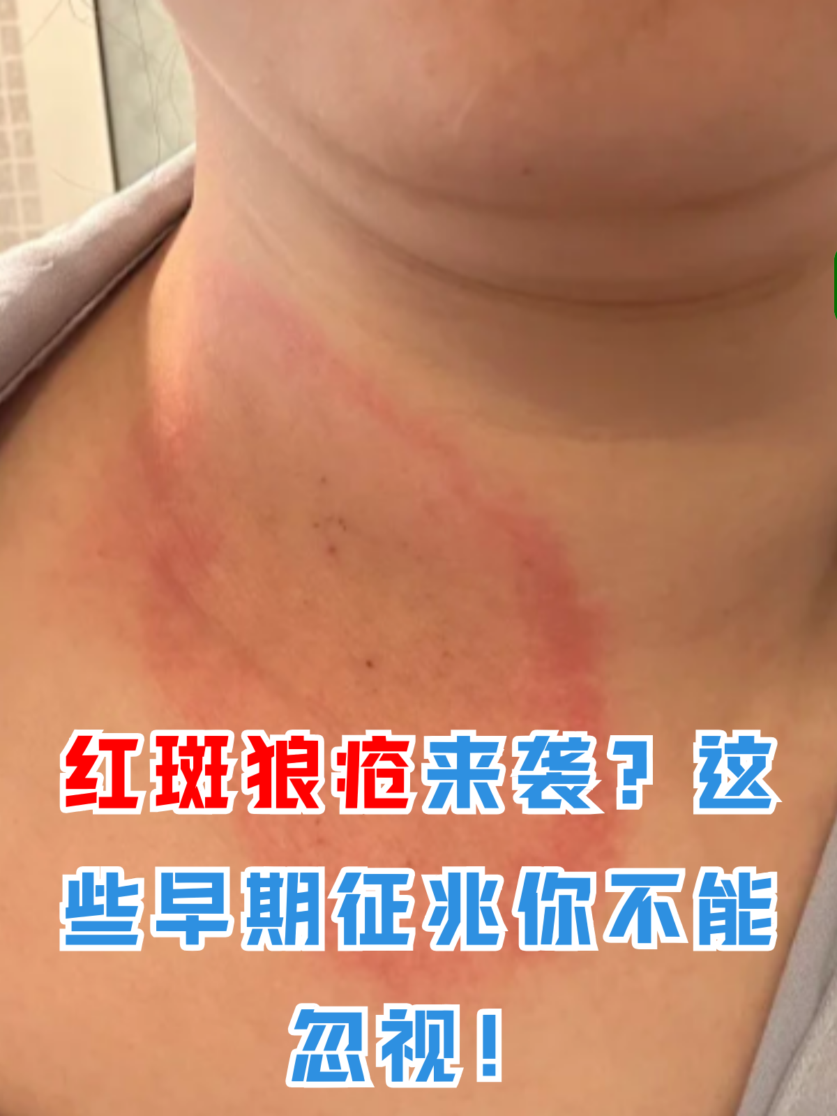 红斑狼疮来袭?这些早期征兆你不能忽视!