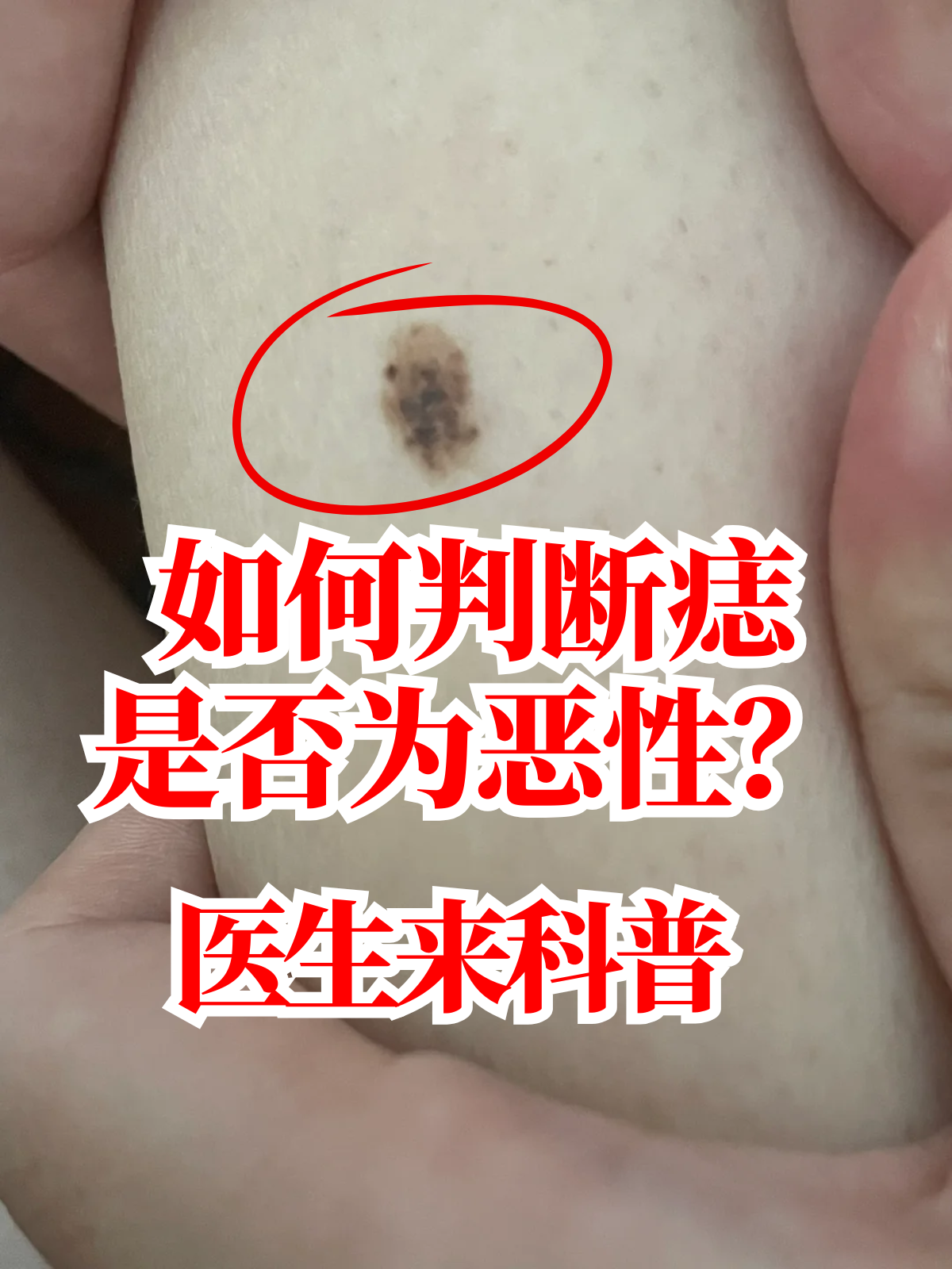 医生来科普 在日常生活中,身上或多或少都会长一些痣