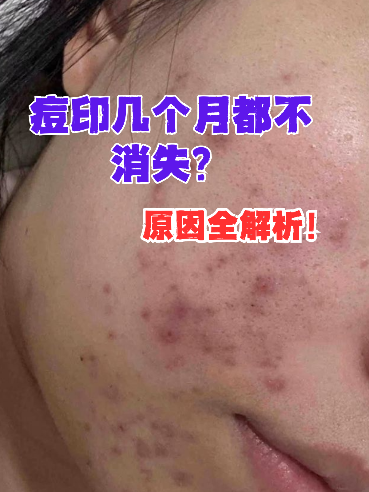 脸上长痘痘已经够糟心了,可痘痘消下去后,痘印却赖着不走,几个月恫换