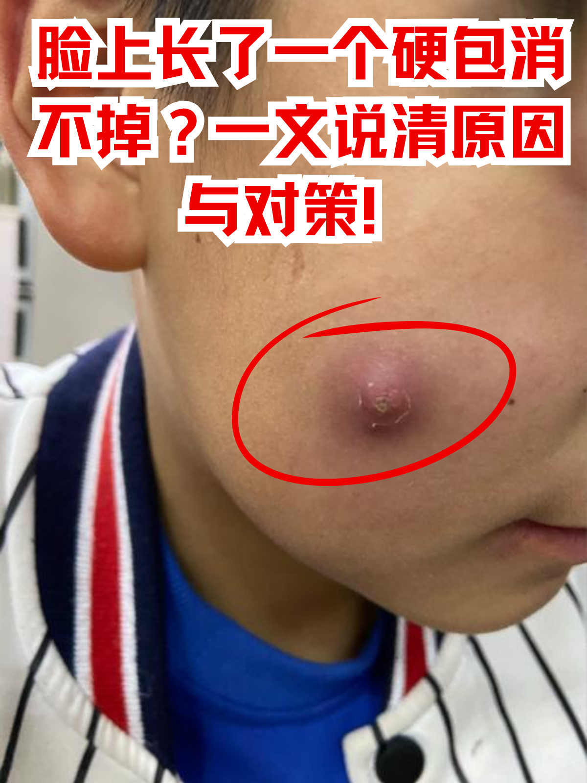 脸上长出的难以消退的硬包,不仅影响美观,还可能隐藏着更深层次的