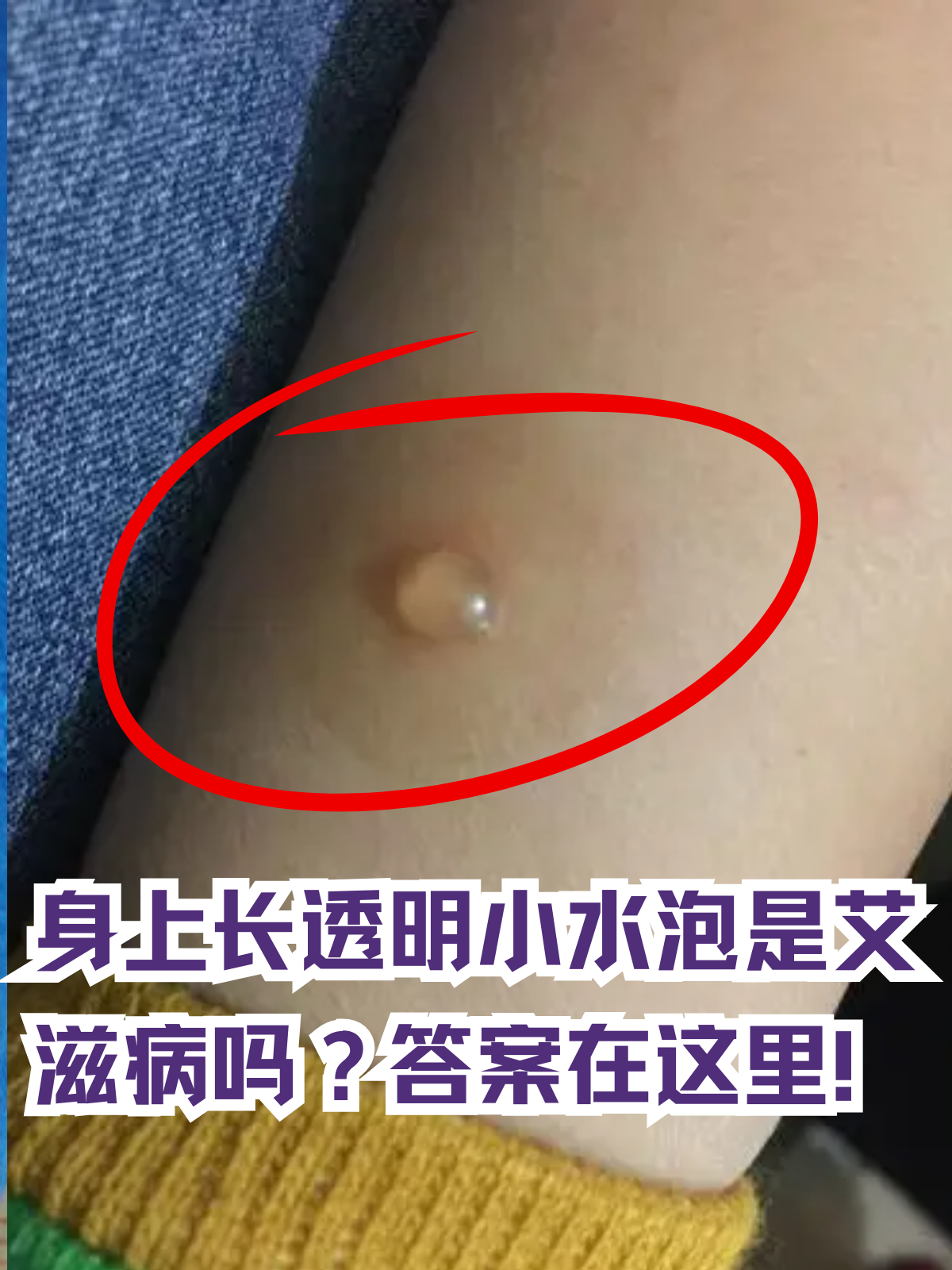 身上长透明小水泡是艾滋病吗?答案在这里!