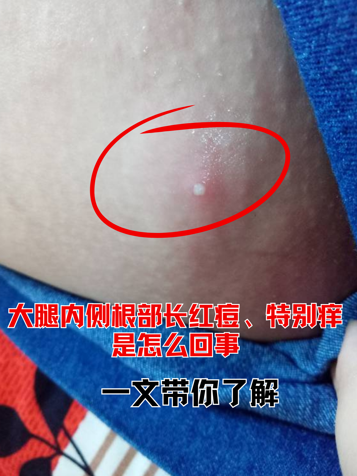 为什么腿很痒