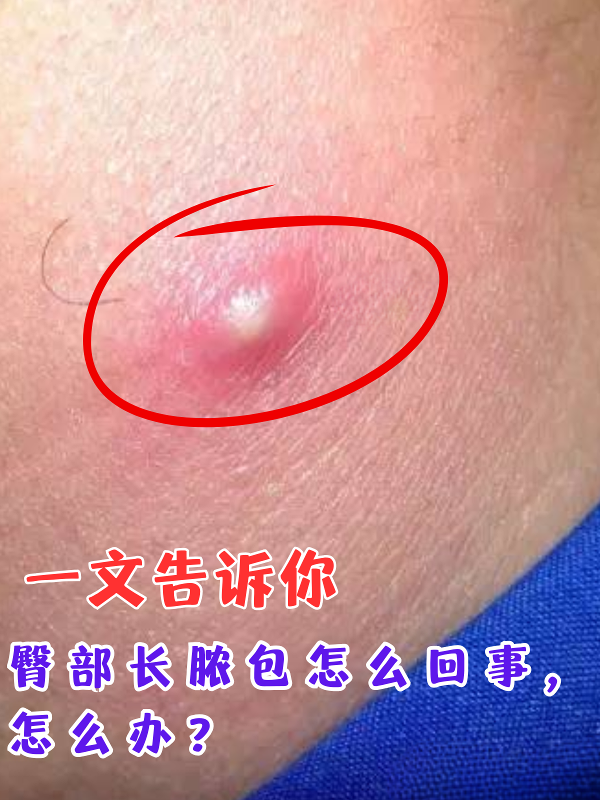 你有没有遇到过这样一个常见但又令人困扰的问题,那就是臀部长脓包