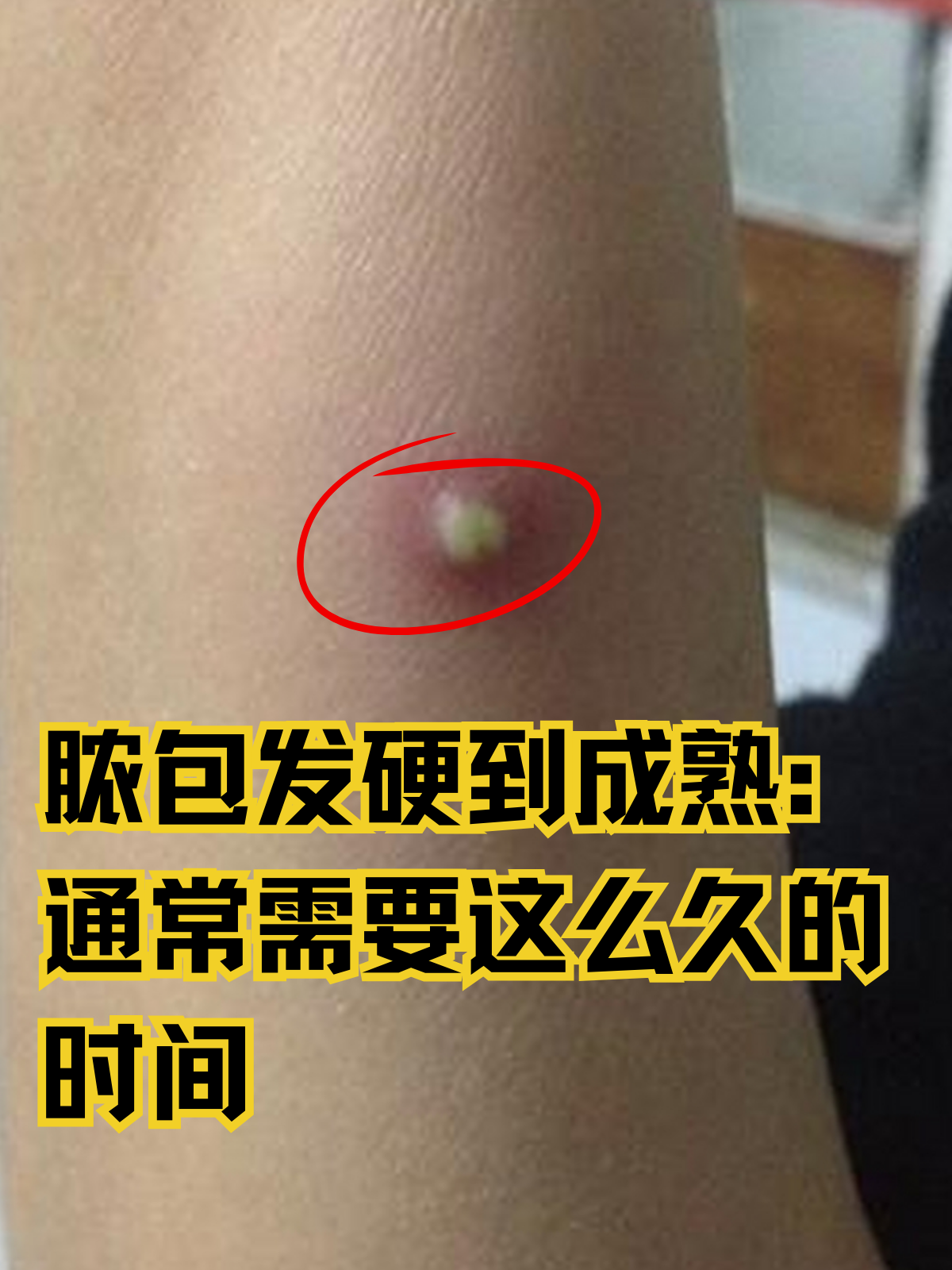 脓包发硬到成熟:通常需要这么久的时间 在日常生活中,皮肤感染是常见