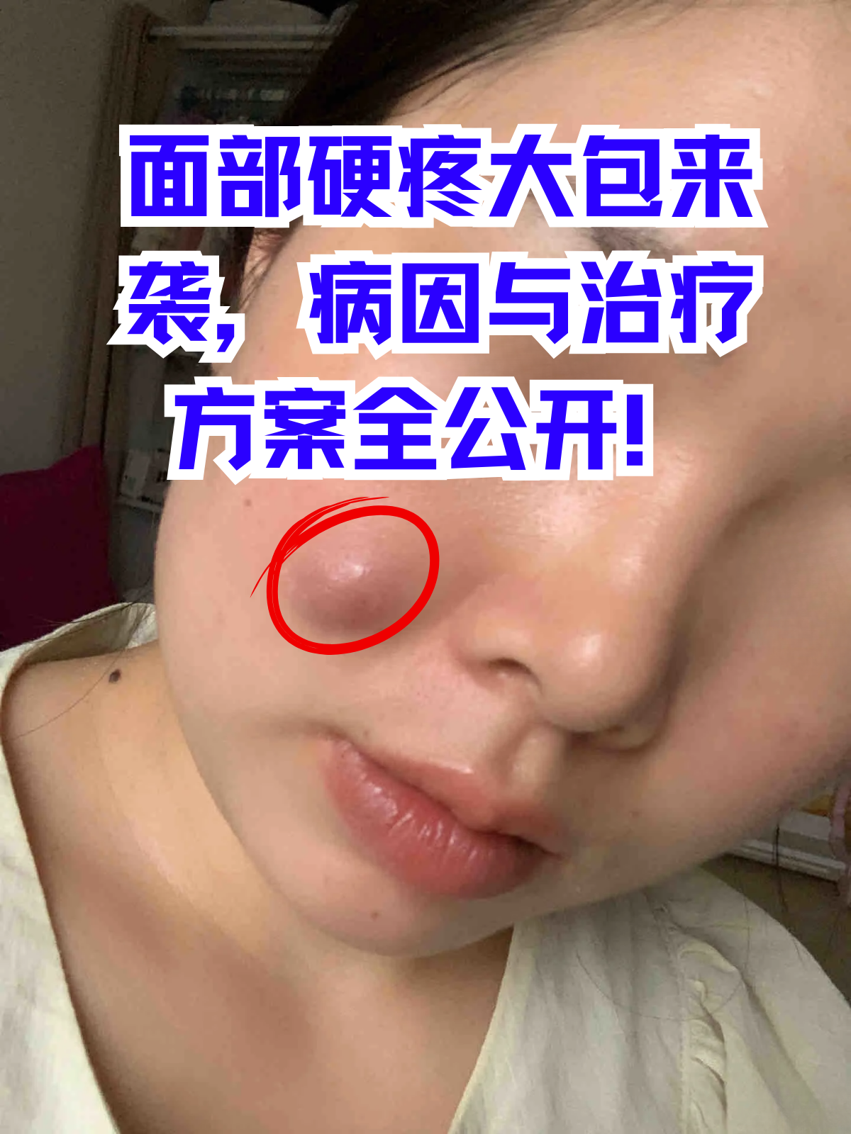 脸上突然冒出又硬又疼的大包,真的很影响心情和颜值