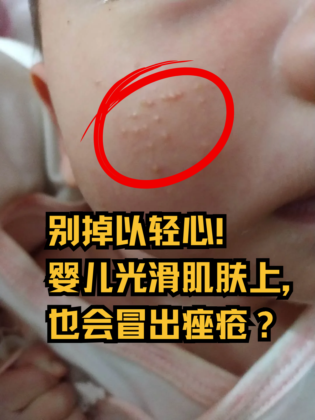 别掉以轻心!婴儿光滑肌肤上,也会冒出痤疮?