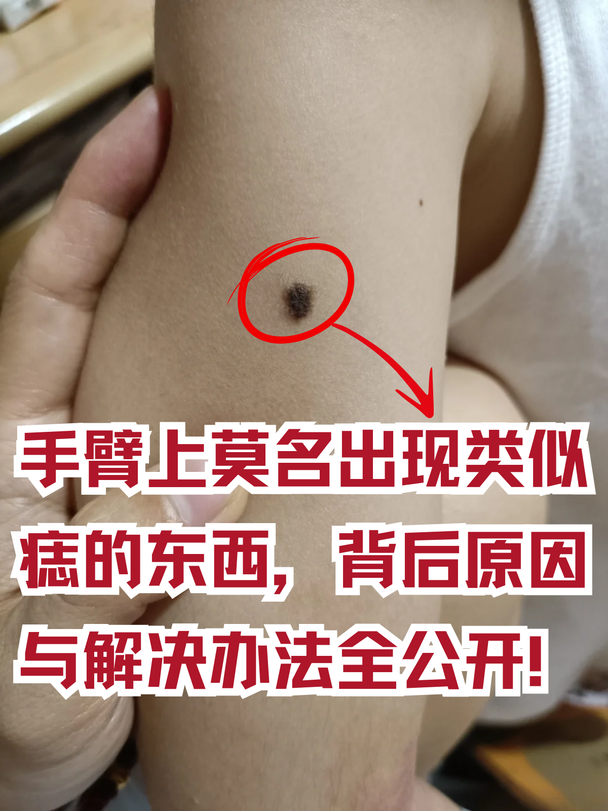 突然发现手臂中间冒出一颗像痣一样的东西,是不是心里充满了疑惑和