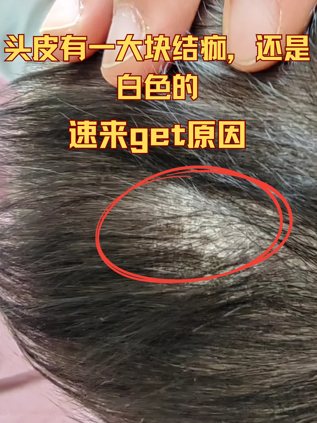 瞬间被这份意外的发现打乱了节奏,头皮上这块白色的结痂究竟从何而来?