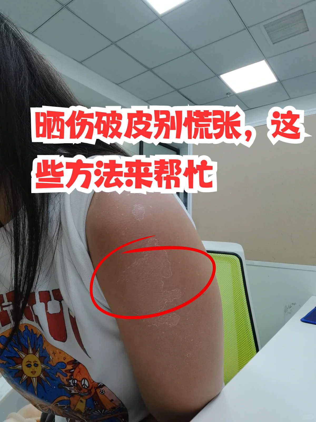 晒伤破皮别慌张,这些方法来帮忙 当户外活动时