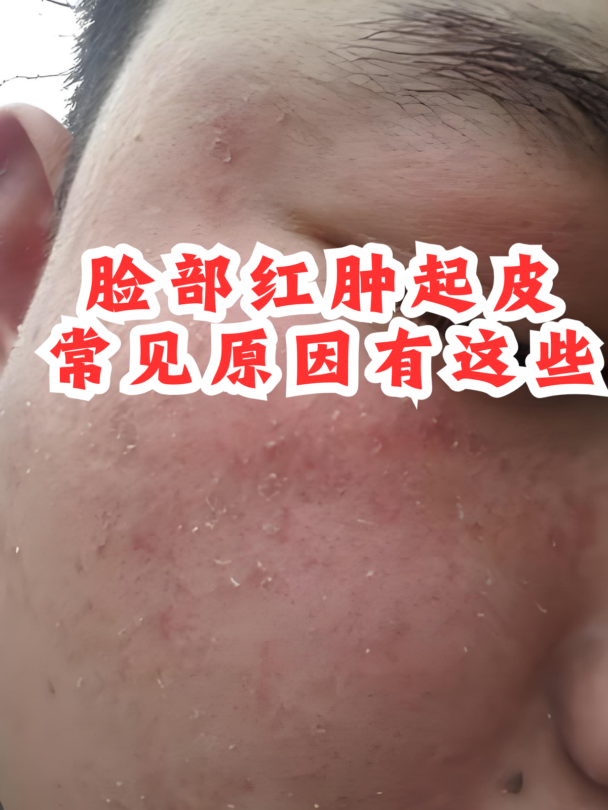 脸部红肿起皮,常见原因有这些 在皮肤问题中,脸部红