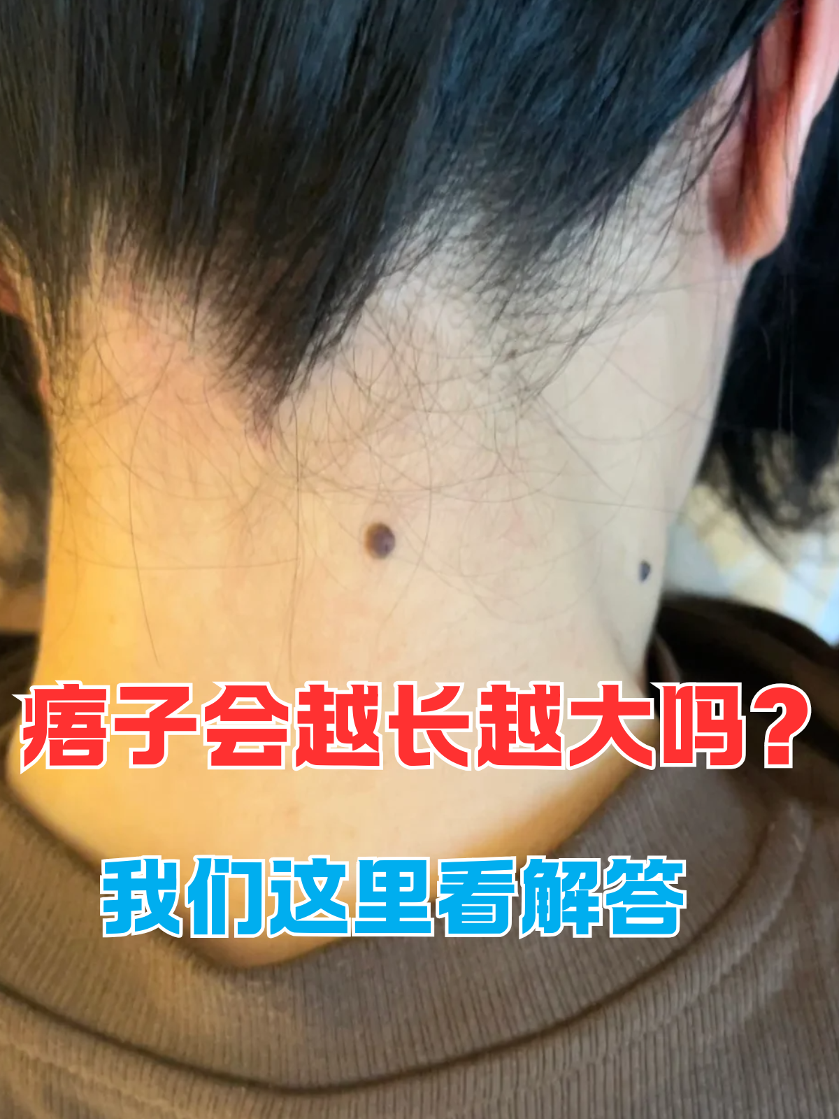 我们这里看解答 痦子在医学上被称为色素痣,是一种最常见的良性皮肤