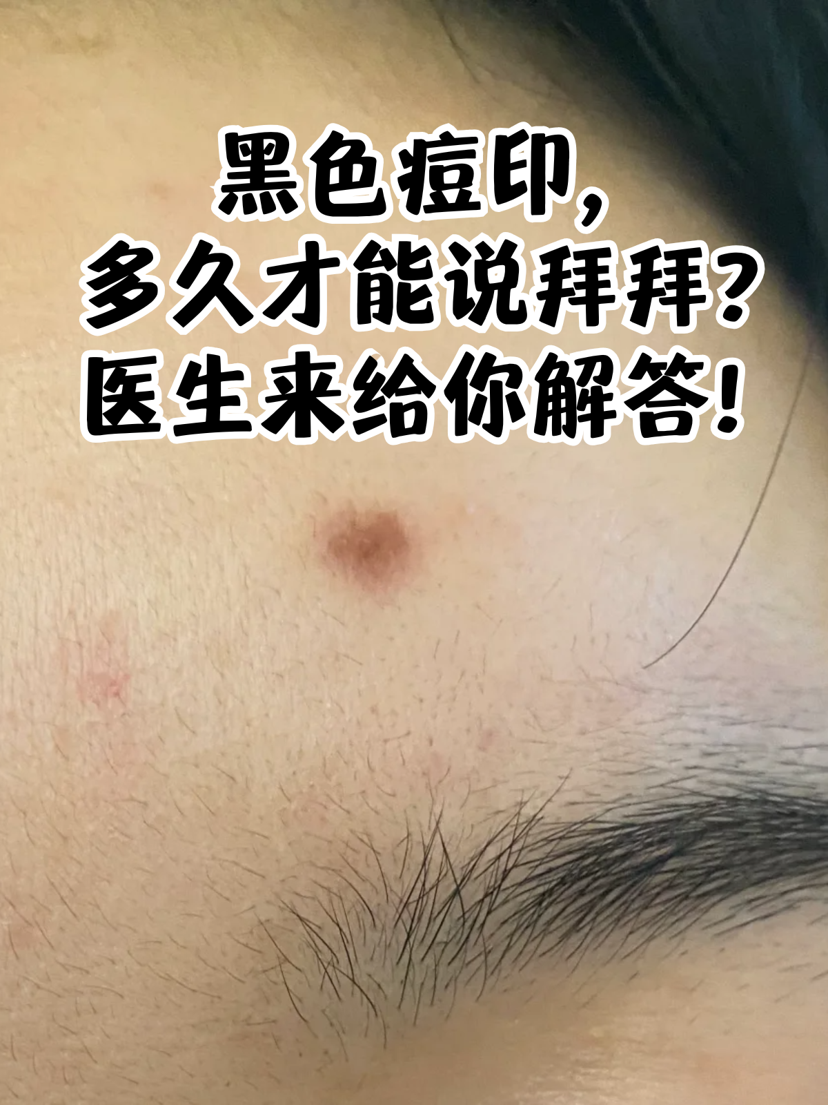 当痘痘发炎时,会刺激皮肤中的黑色素细胞产生更多的黑色素,这些黑